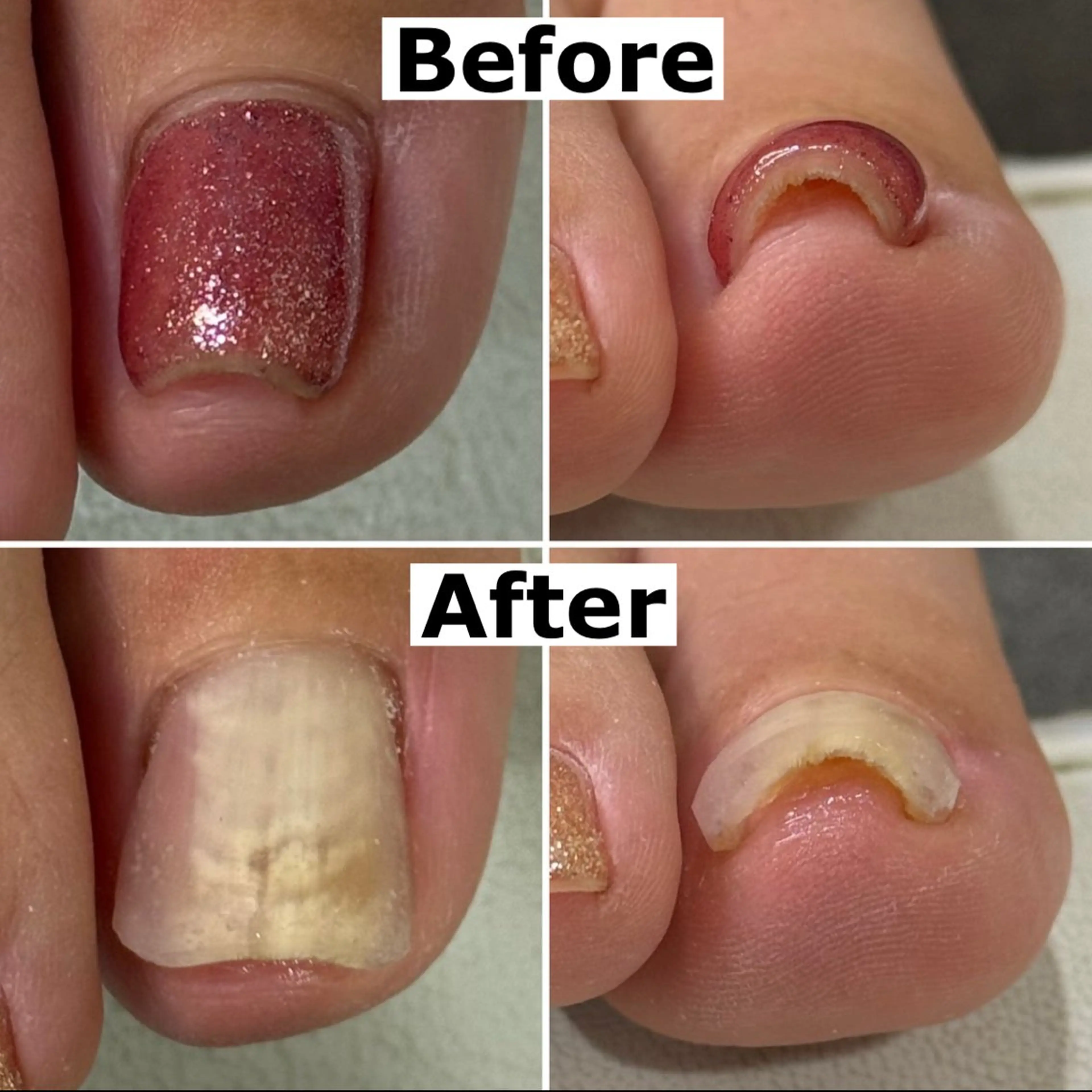 ネイル Mellow nail所属・巻爪無料モデル募集 ✨🦶MEGUMIのネイルデザイン