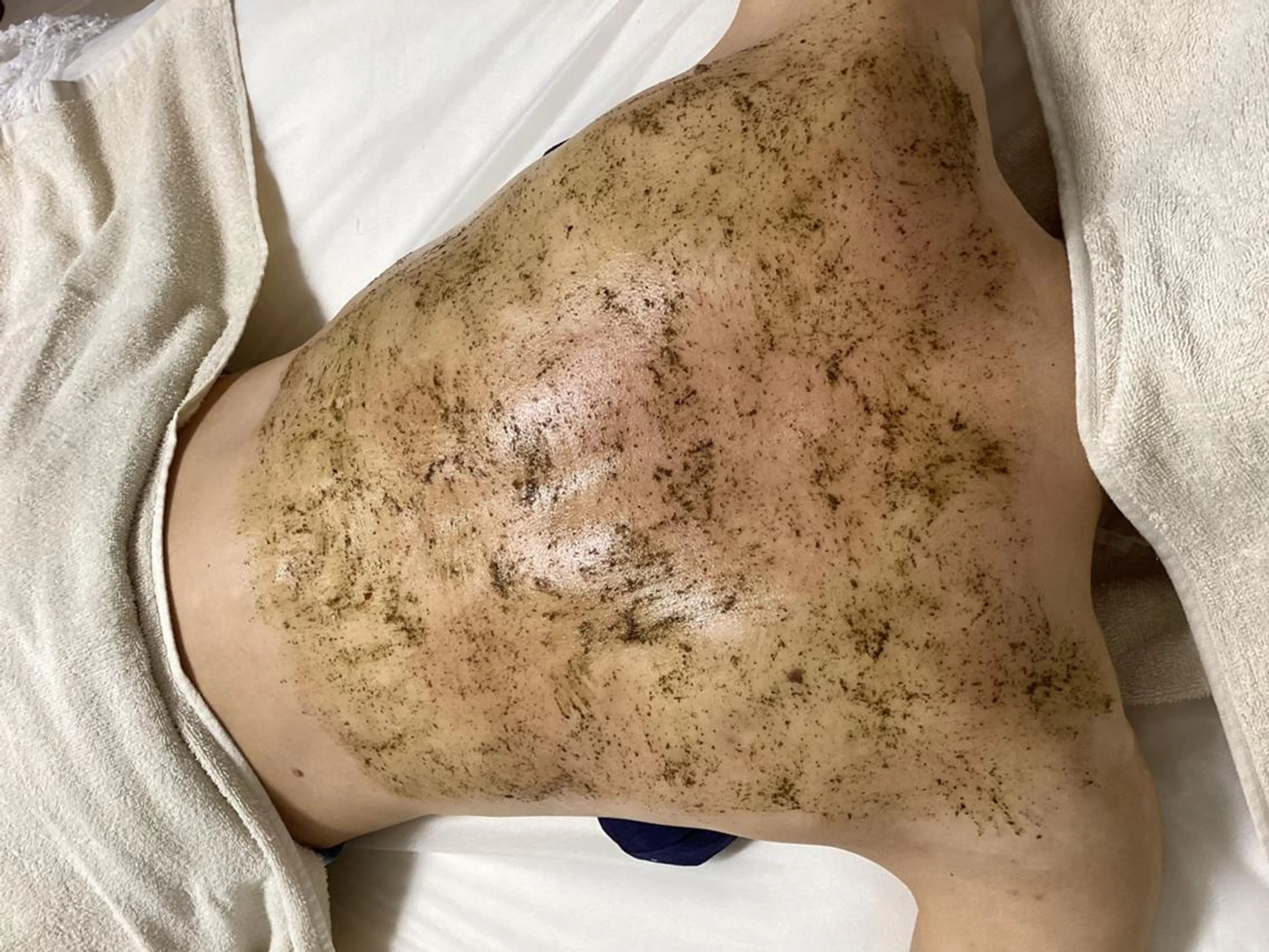 背中ニキビケア上部or 下部（約70分）の写真