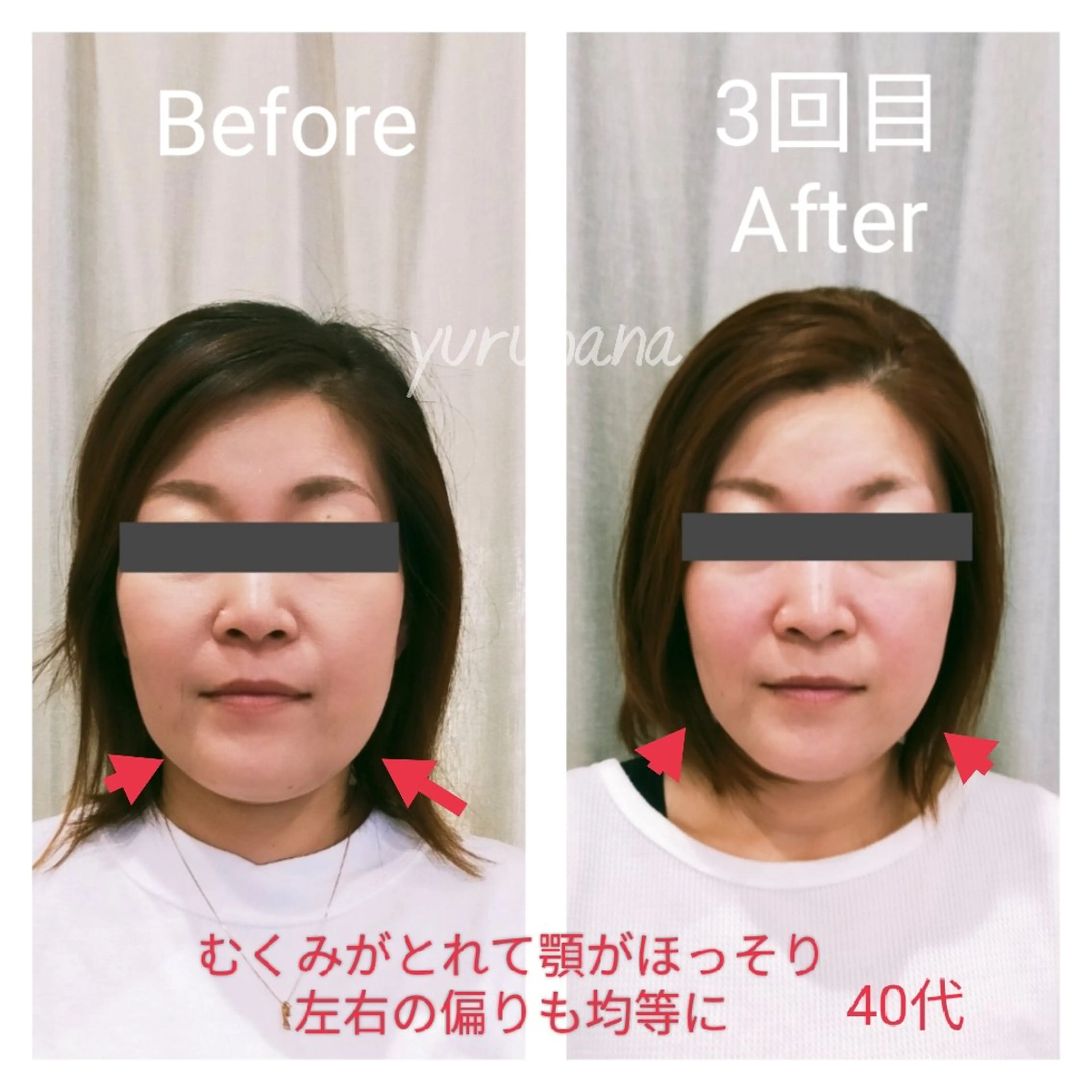 極上リフトアップ《人気No.1❤️リフトアップ／目ヂカラup／ほうれい線／ヘッドスパ》小顔矯正とヘッドコース（60分）の写真