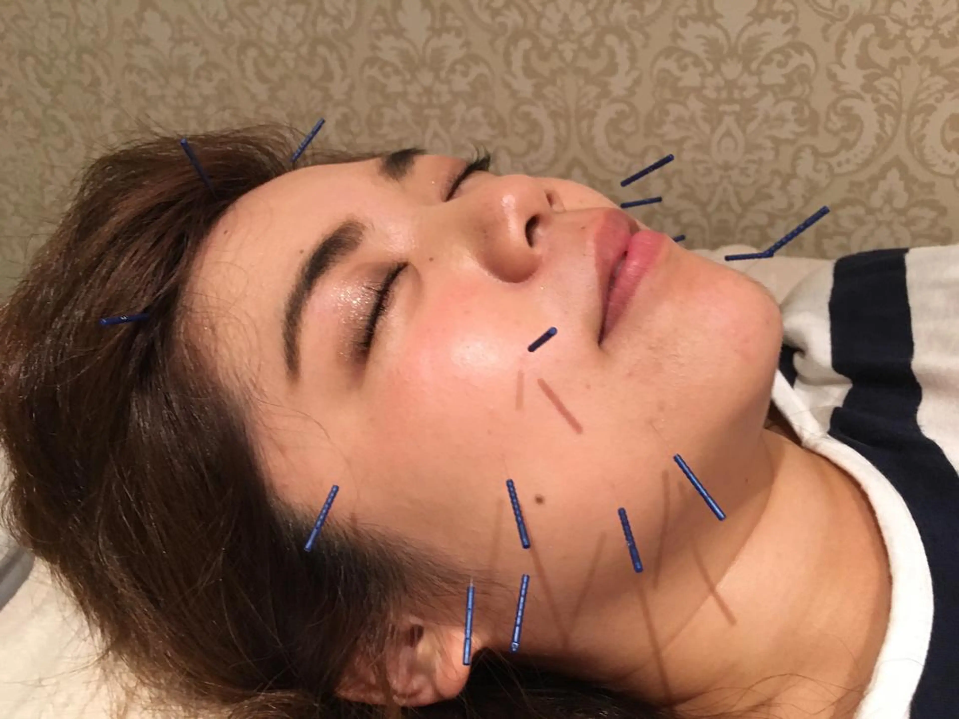 美容鍼サロン    Fleurir所属・伊藤 かなえのエステ・リラクイメージ