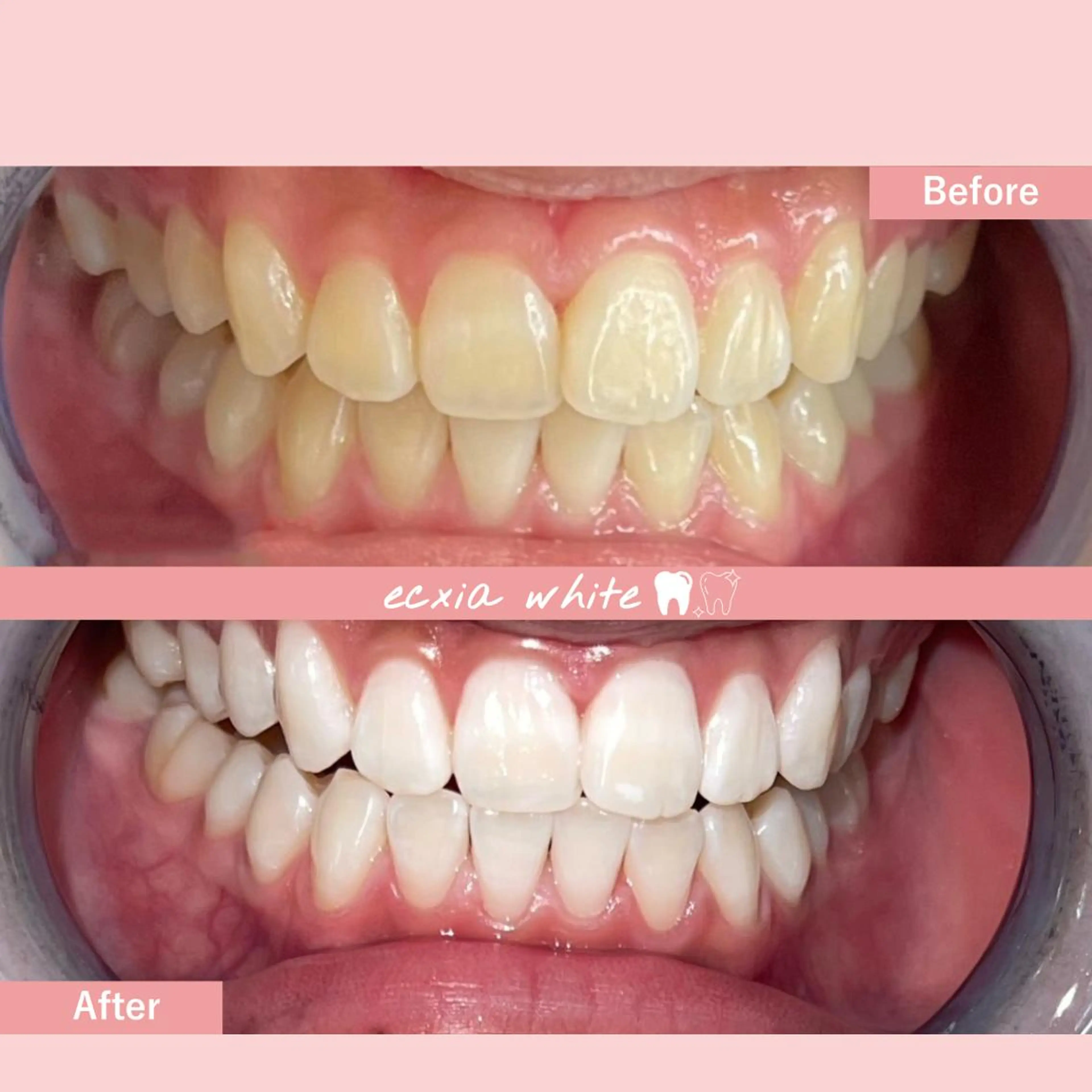 【初回から一気に白く♪】セルフホワイトニング照射15分×3回¥6980→¥2980［札幌/ホワイトニング/すすきの］の写真