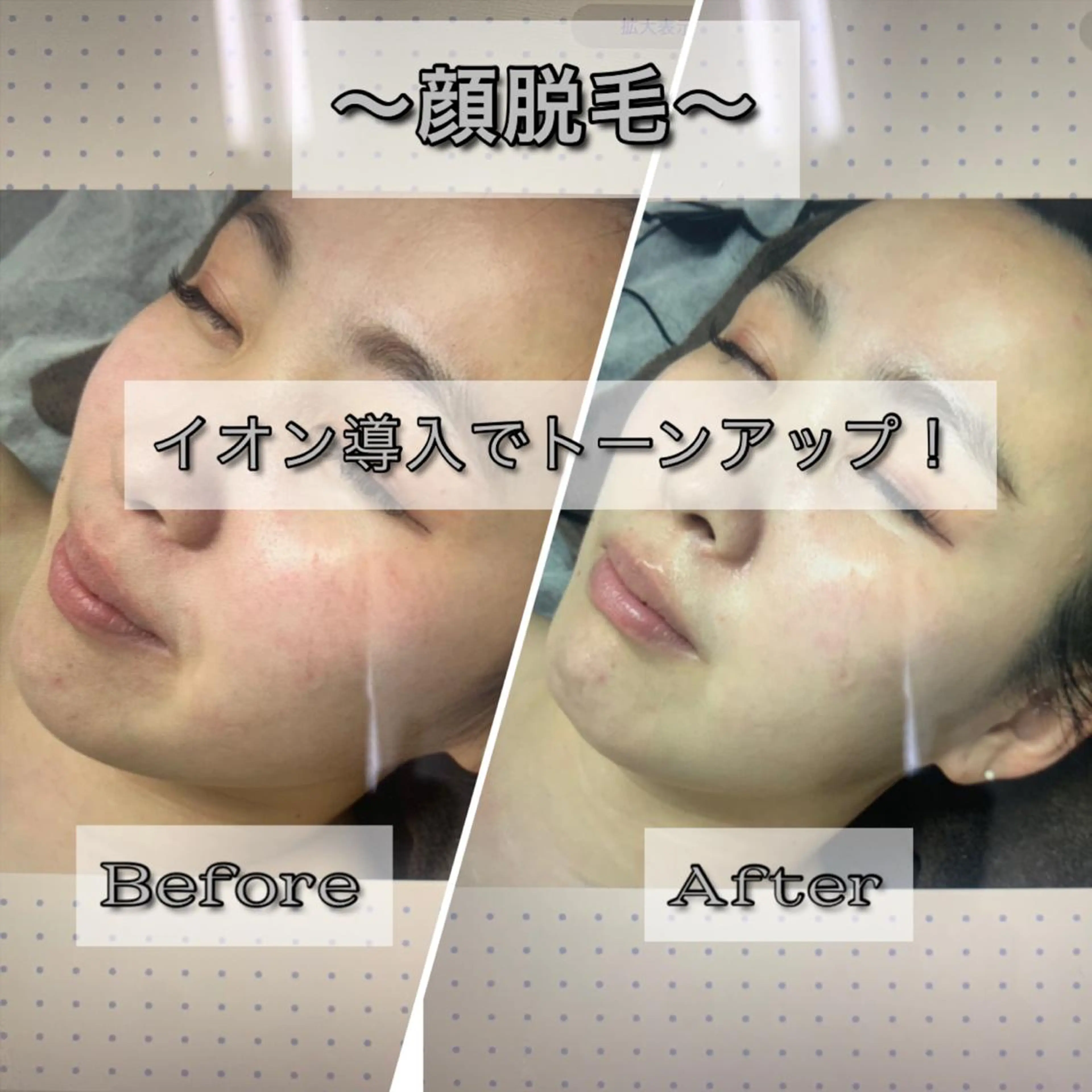 脱毛 脱毛サロン NR エヌアール所属・NR Nara yukiのエステ・リラクイメージ