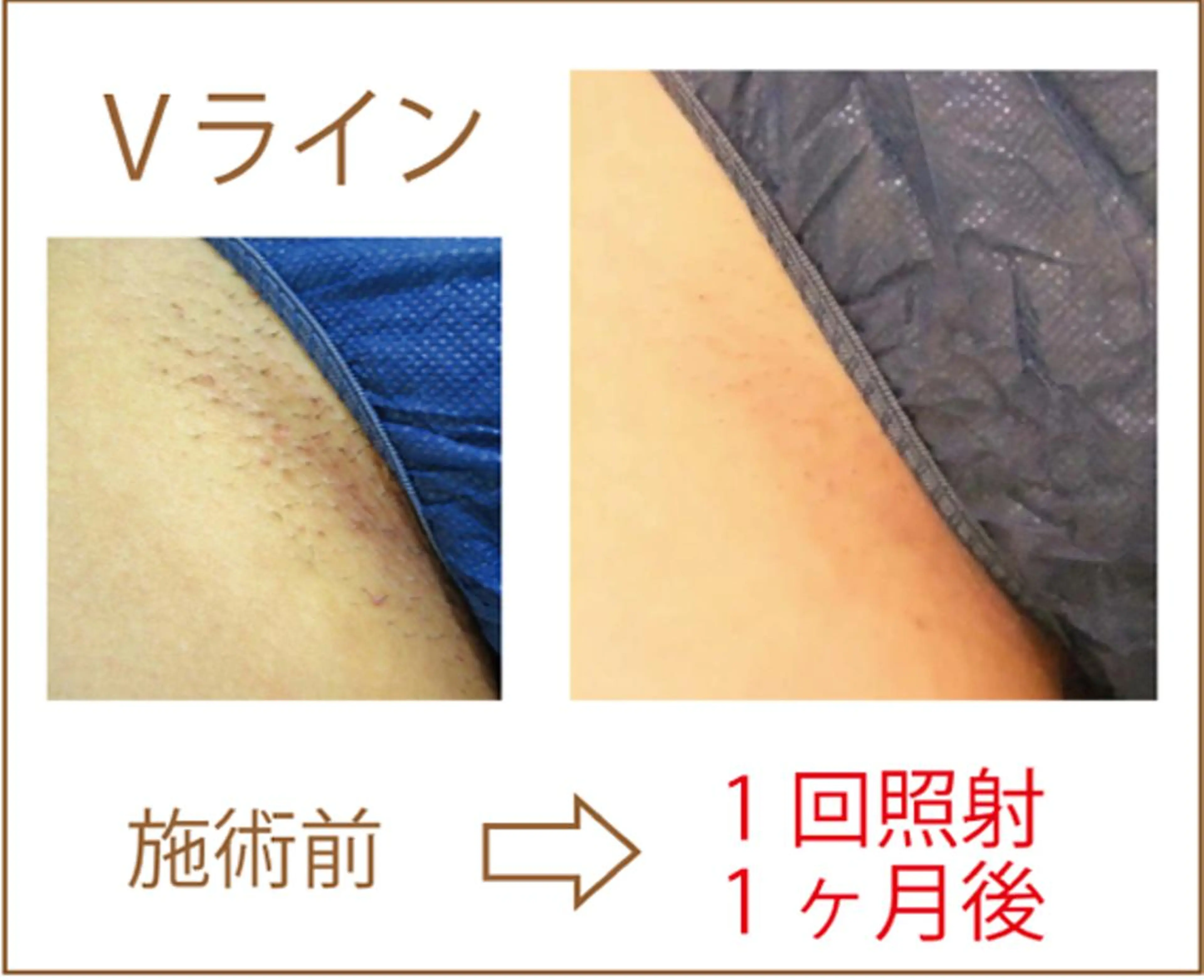 大人気箇所♡VIOお試し特別価格！通常13000円→半額！6500円の写真