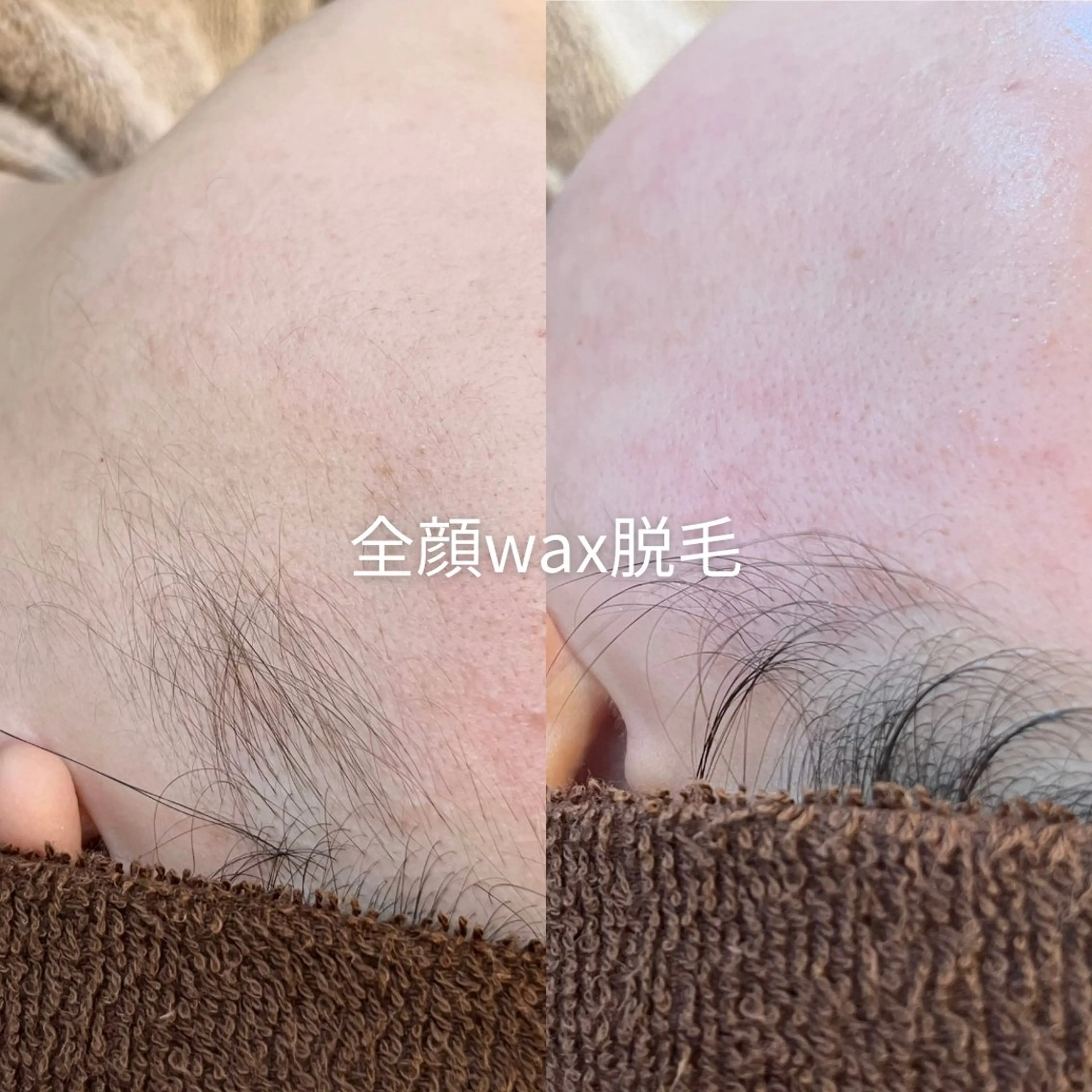脱毛 EST BEAUTY所属・顔ワックス脱毛/ ハーブピーリングのエステ・リラクイメージ