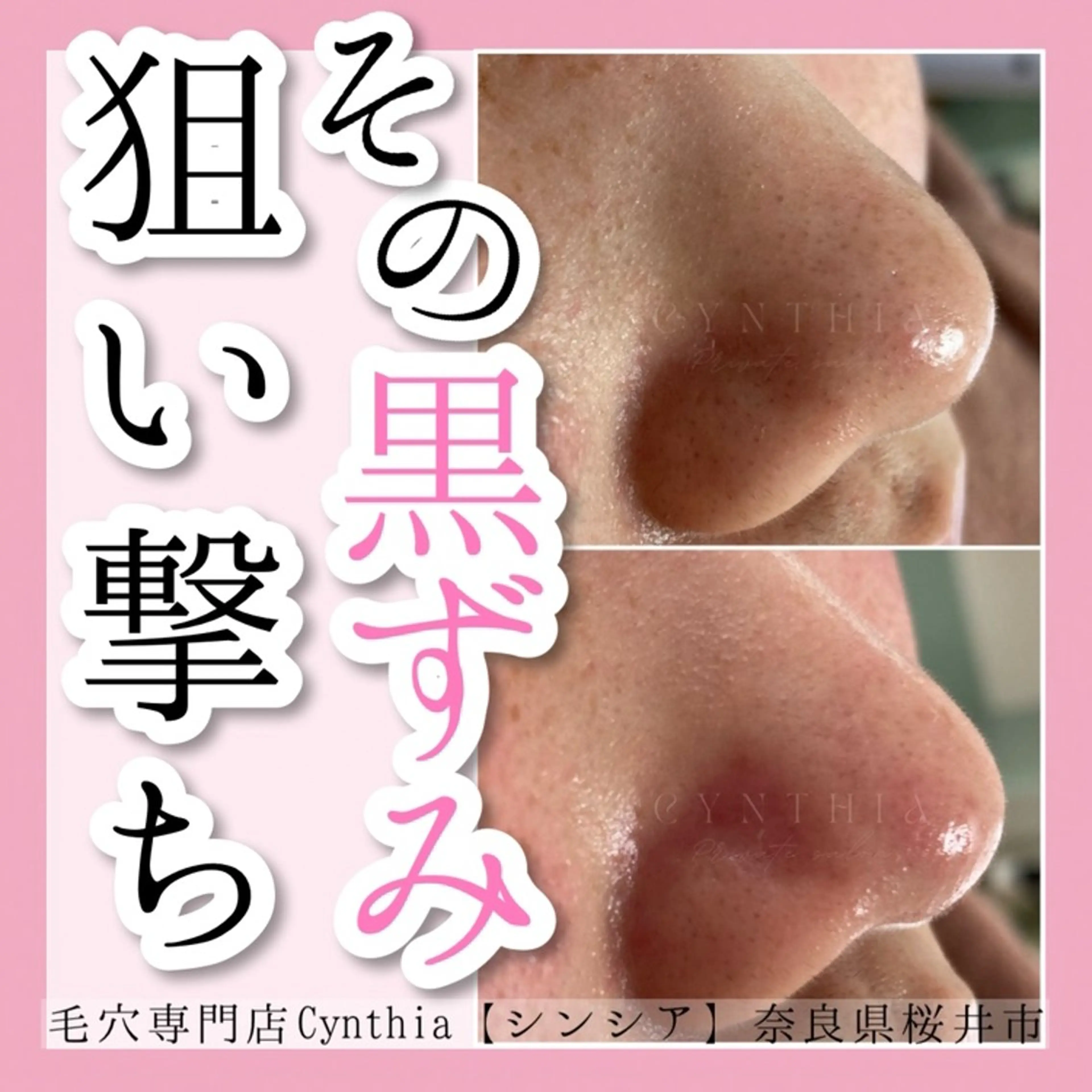 毛穴ケア【スタンダード】ヘッド付の写真