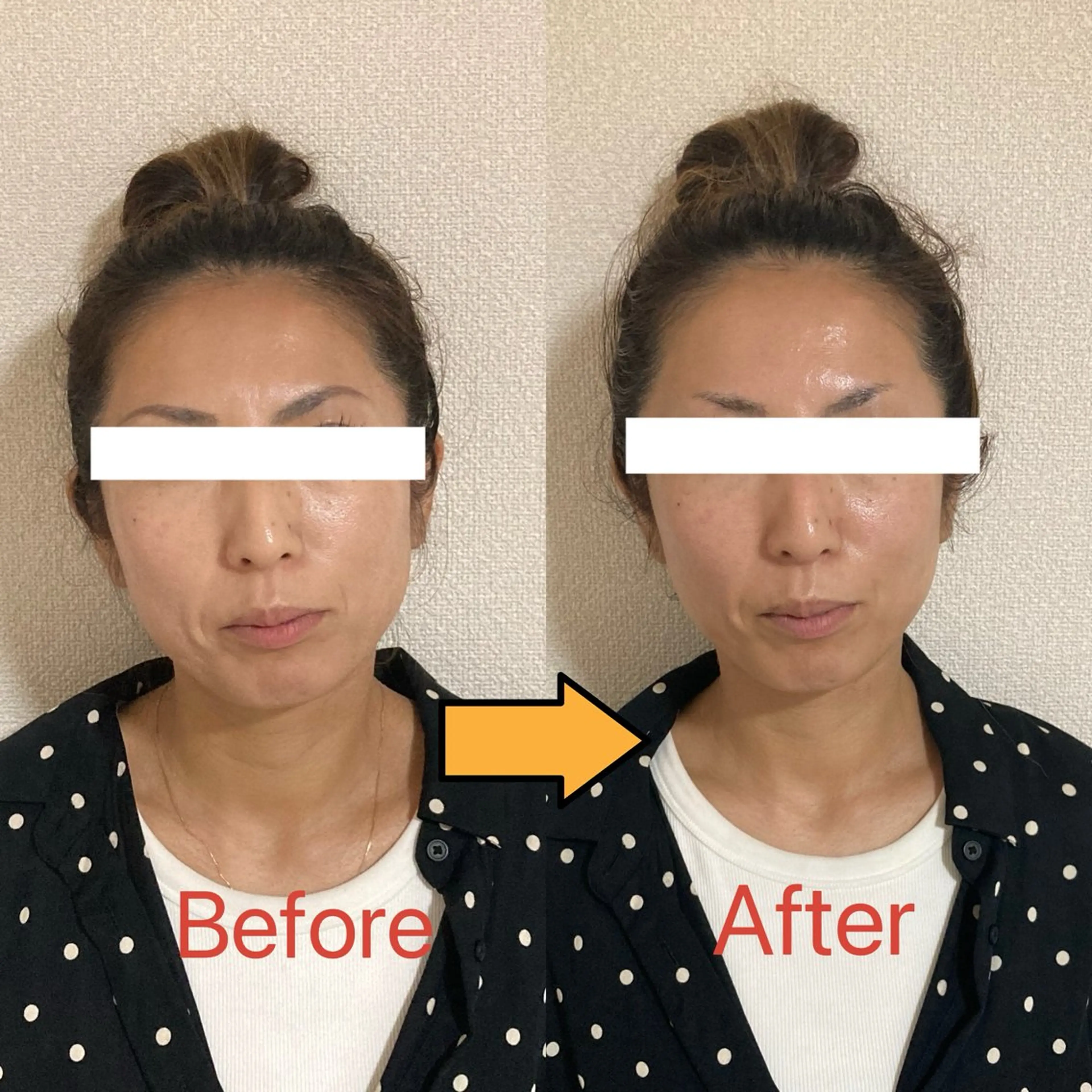 【初回お試し価格❣️】エステ版ポテンツァ(エクソソーム導入)/2回目からはお得な回数券有り♪の写真