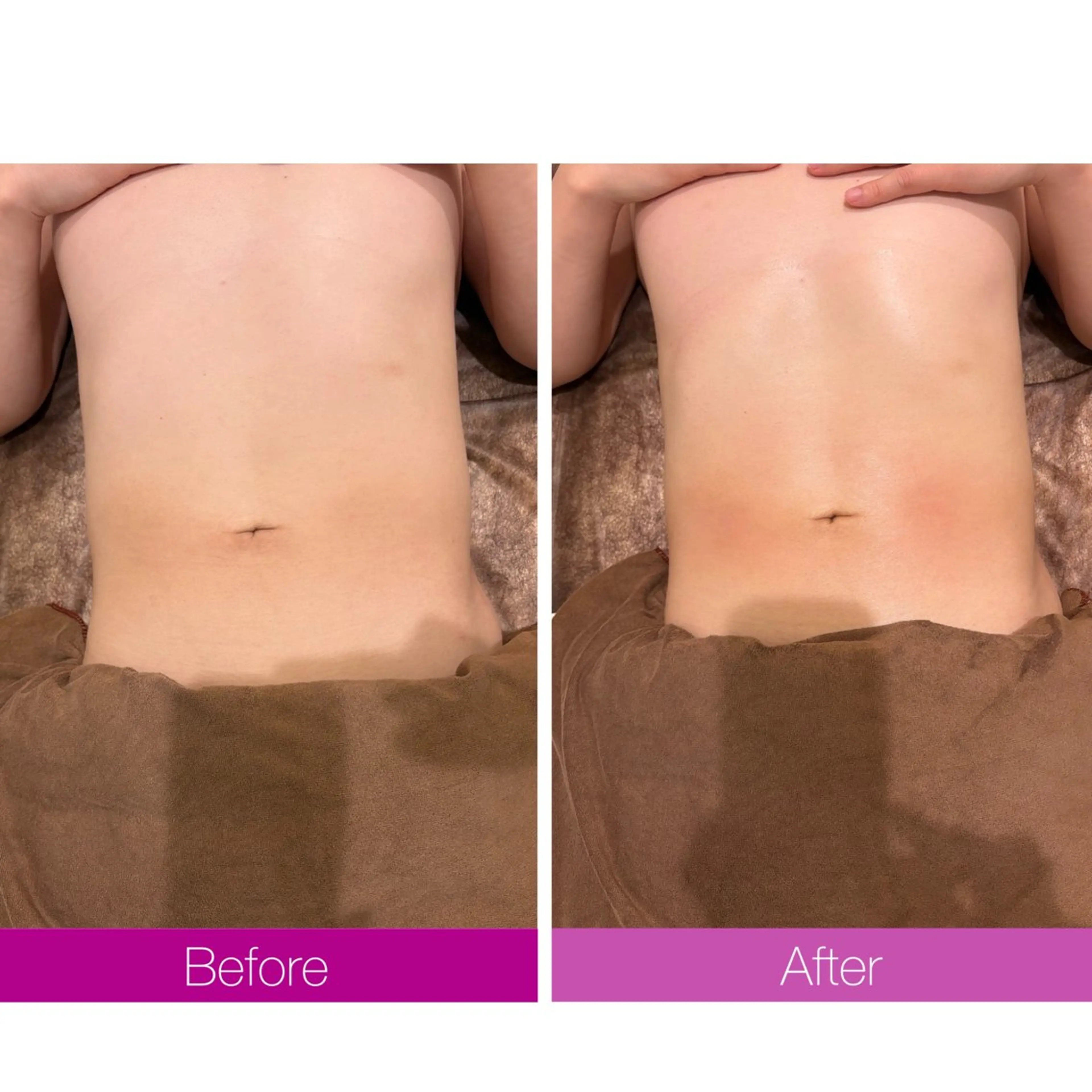 ☆痩身/小顔☆ ハイパーナイフexのエステ・リラクイメージ