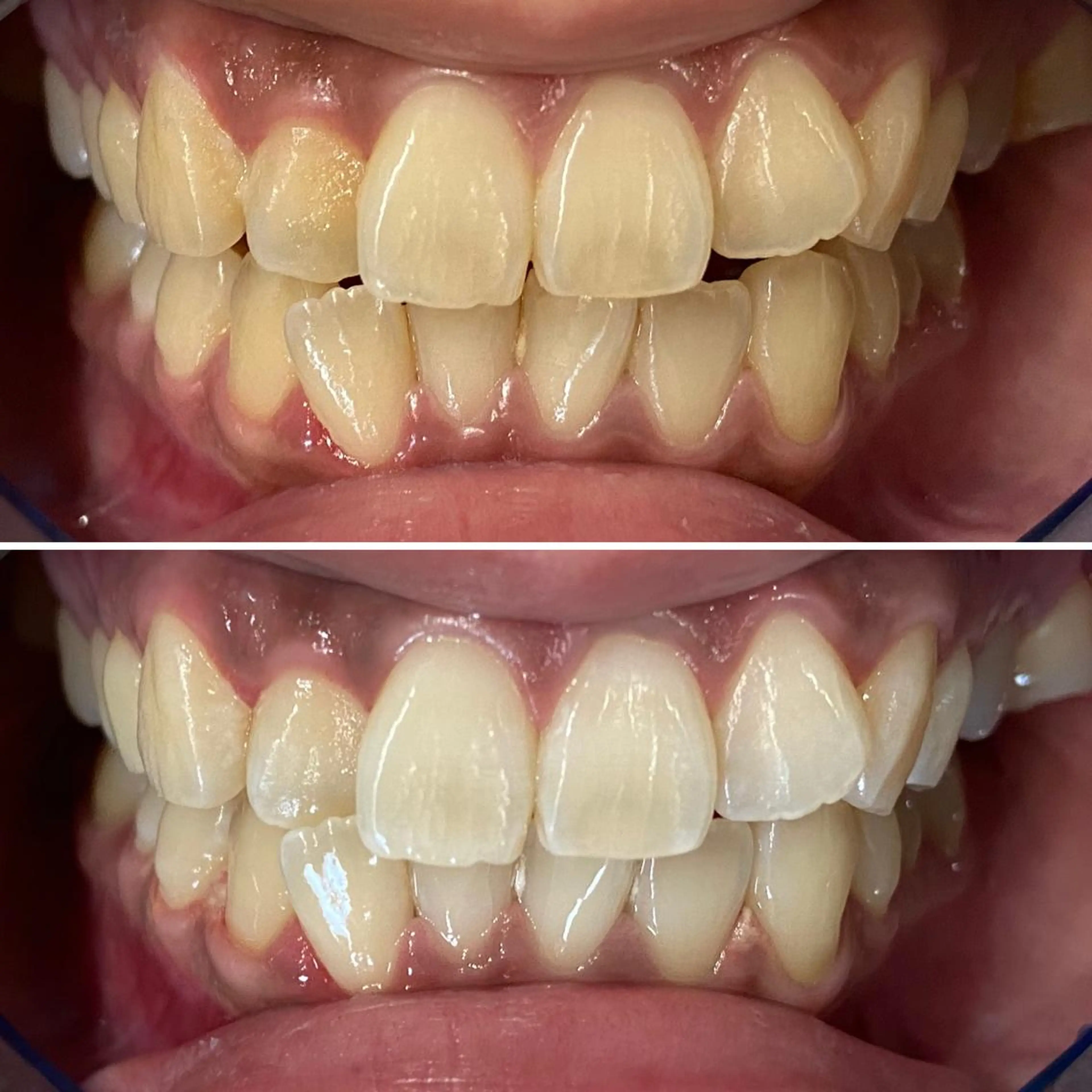 その他 ホワイトニング ⚓︎CREW柏⚓︎のその他イメージ