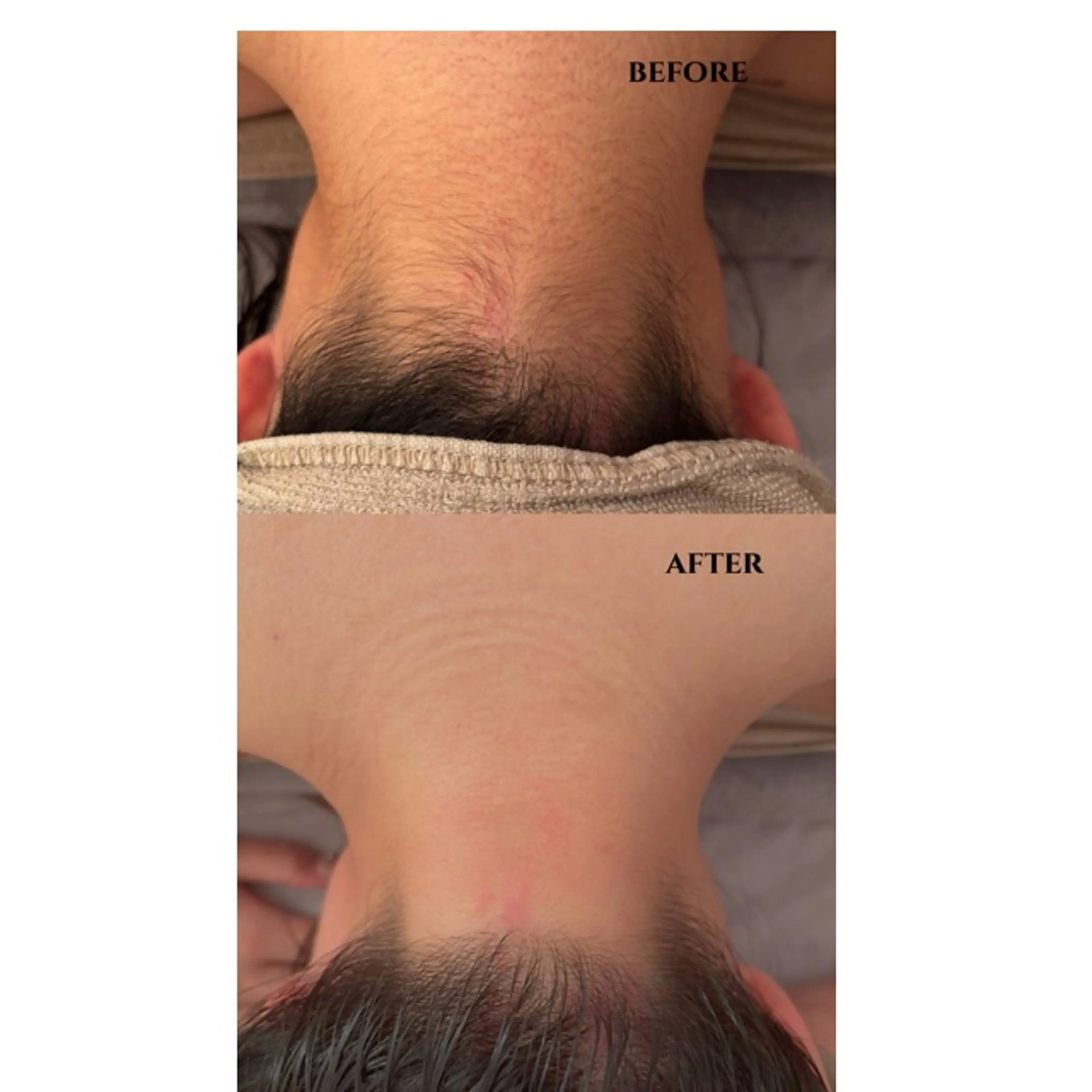 うなじの脱毛の写真