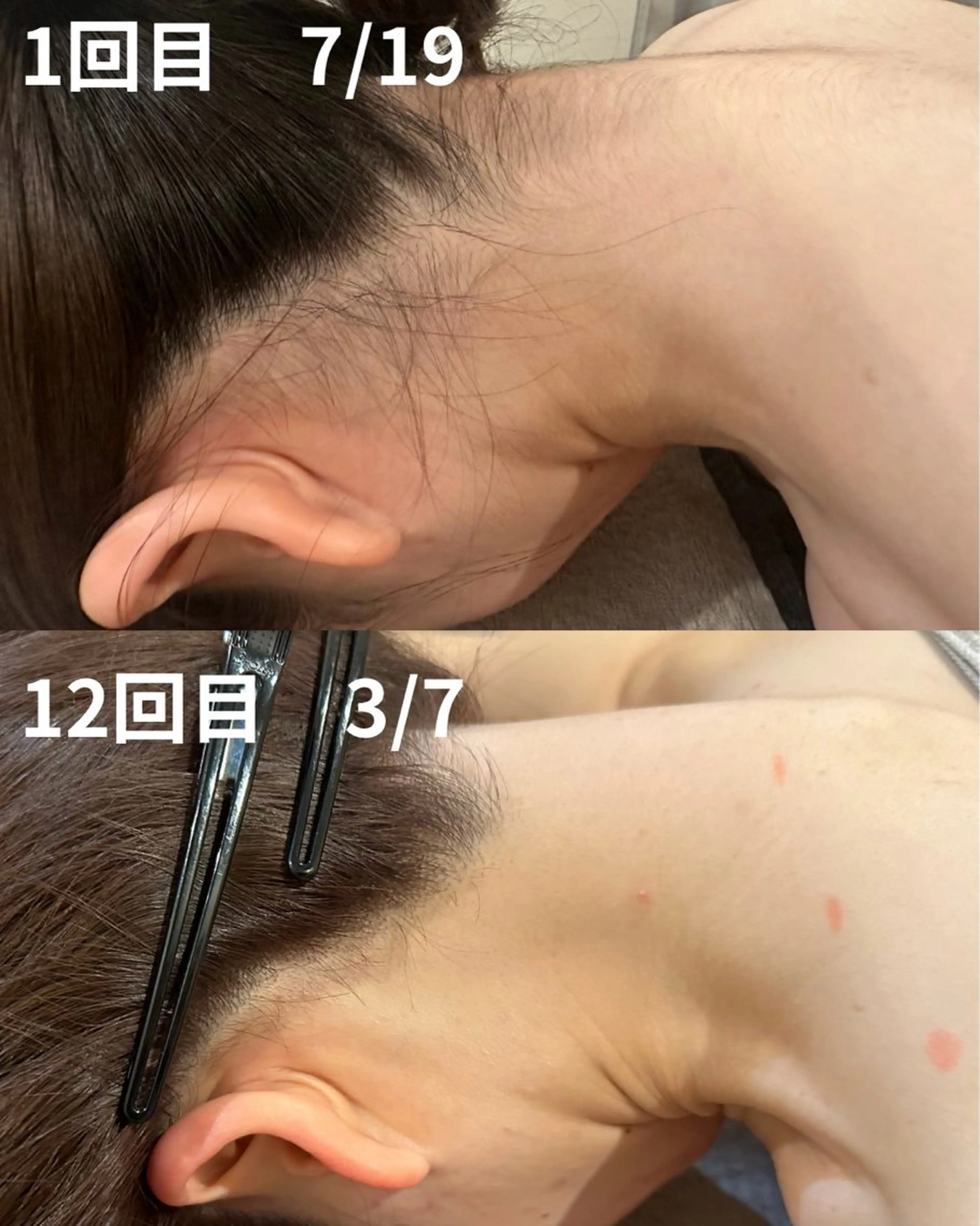 【ミニモ学割】ポニーテールがもっと可愛い💖うなじ脱毛　¥1,650の写真