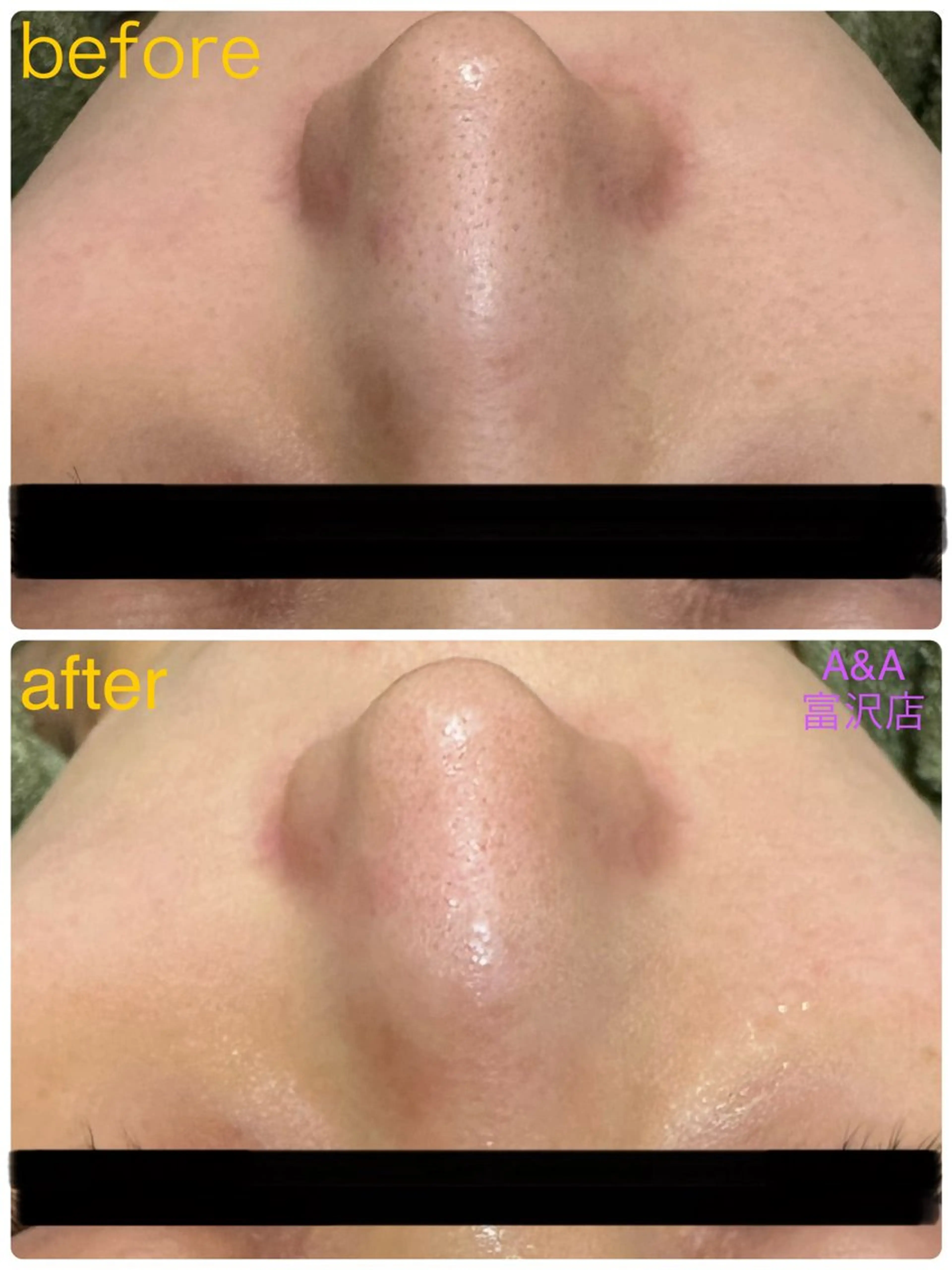 【いちご鼻🍓涙毛穴】毛穴深部洗浄SPコースの写真