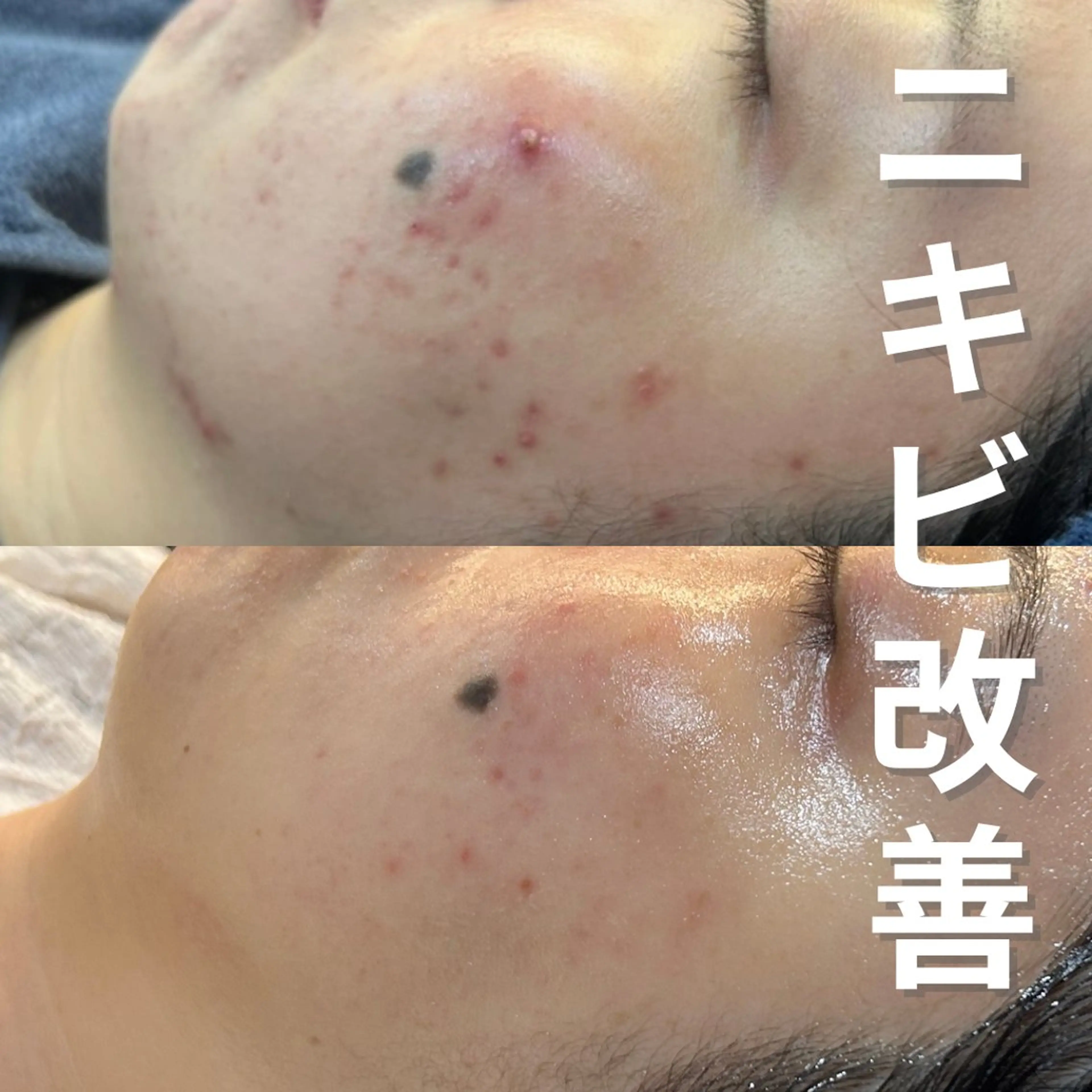 エステ ニキビ・ニキビ跡改善 leoloのエステ・リラクイメージ