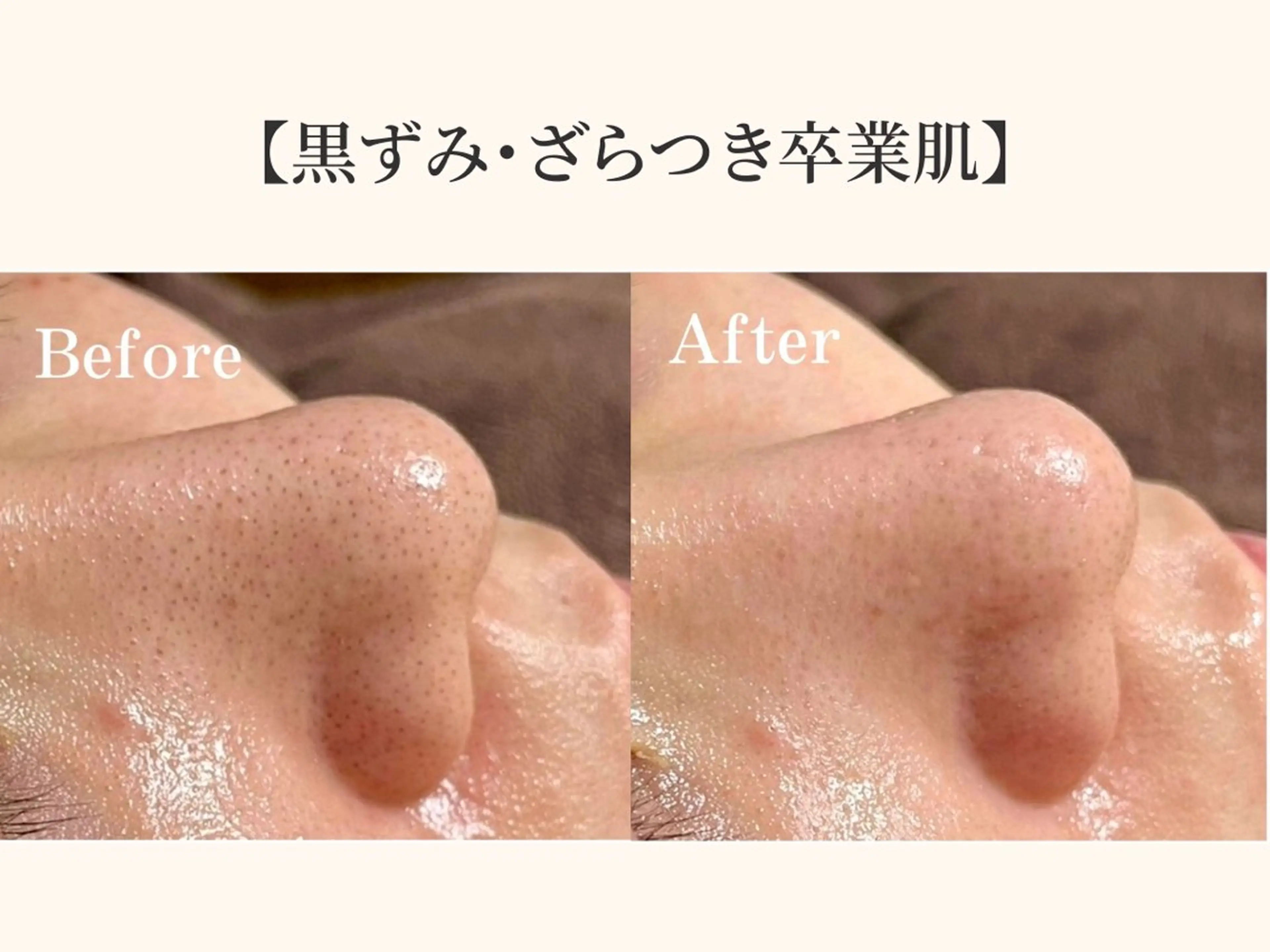 毛穴ケア専門サロン＆ドライヘッドスパ【毛穴洗浄 | ララピール】DREAM SPA町田店所属・小顔矯正×毛穴サロン DRRAMSPA町田のエステ・リラクイメージ