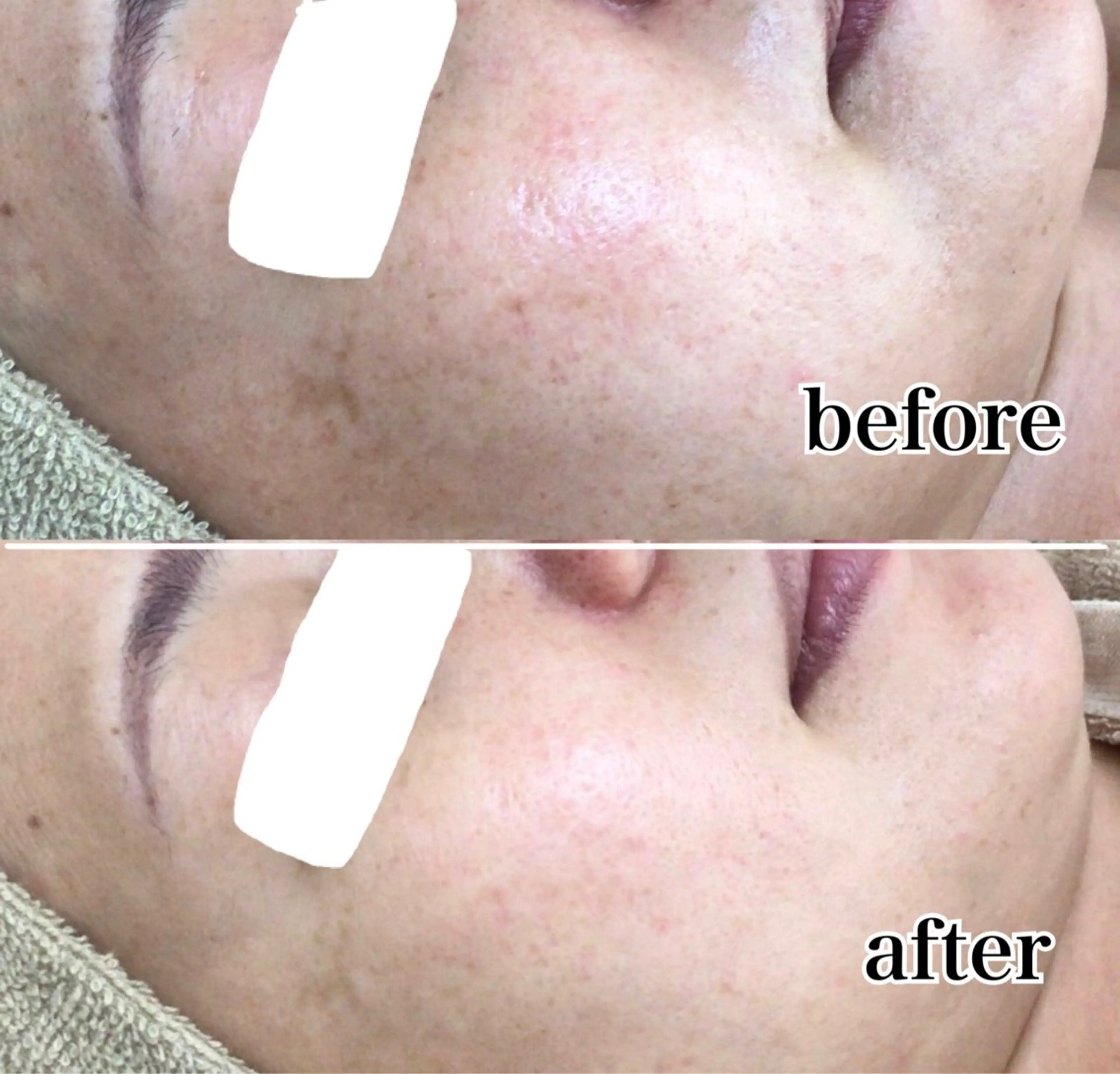 【シミ】光フェイシャル美白コース（デコルテ&お顔リンパマッサージ含む）の写真