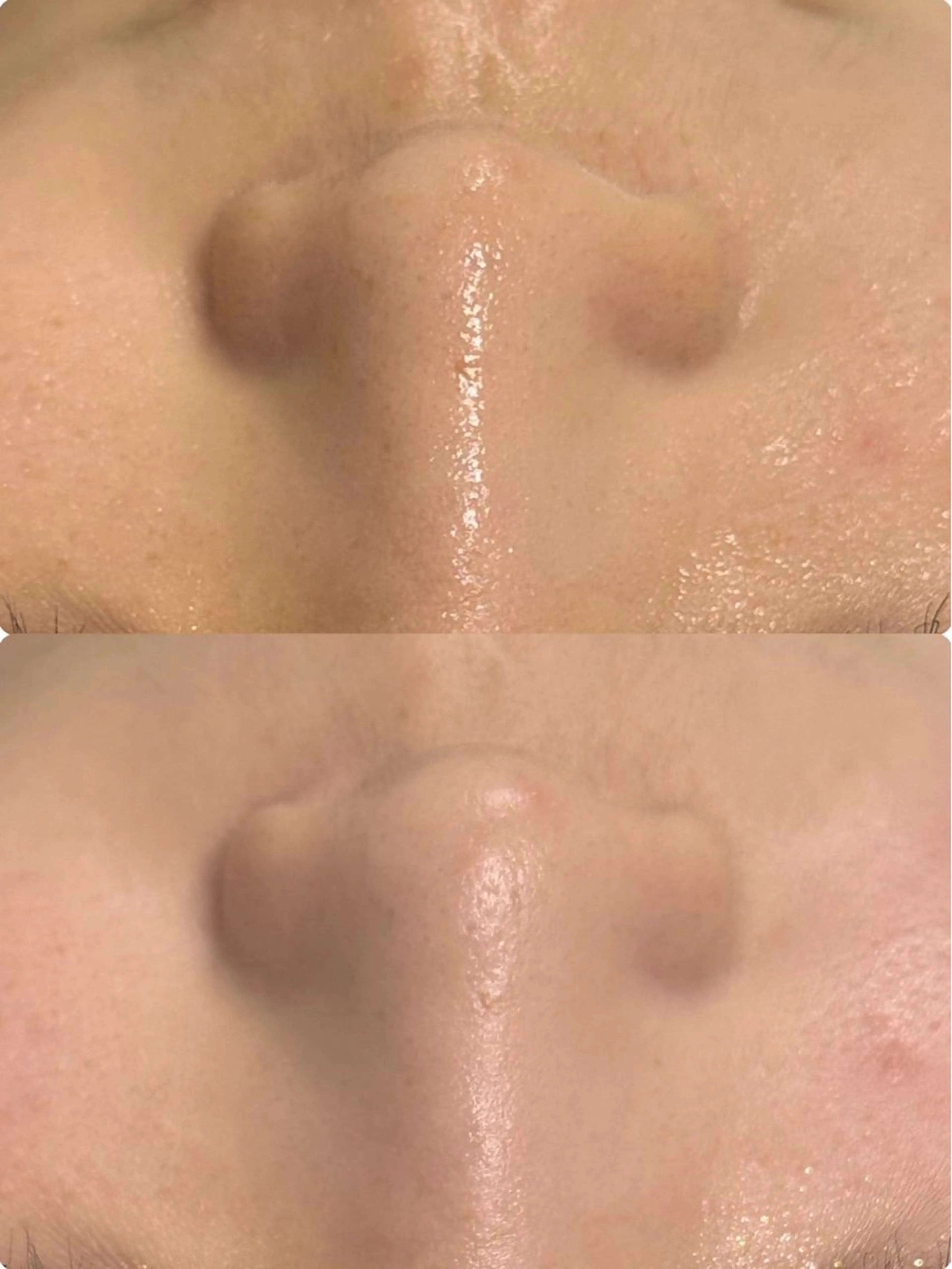 【毛穴の黒ずみ除去】毛穴洗浄×保湿潤パックの写真