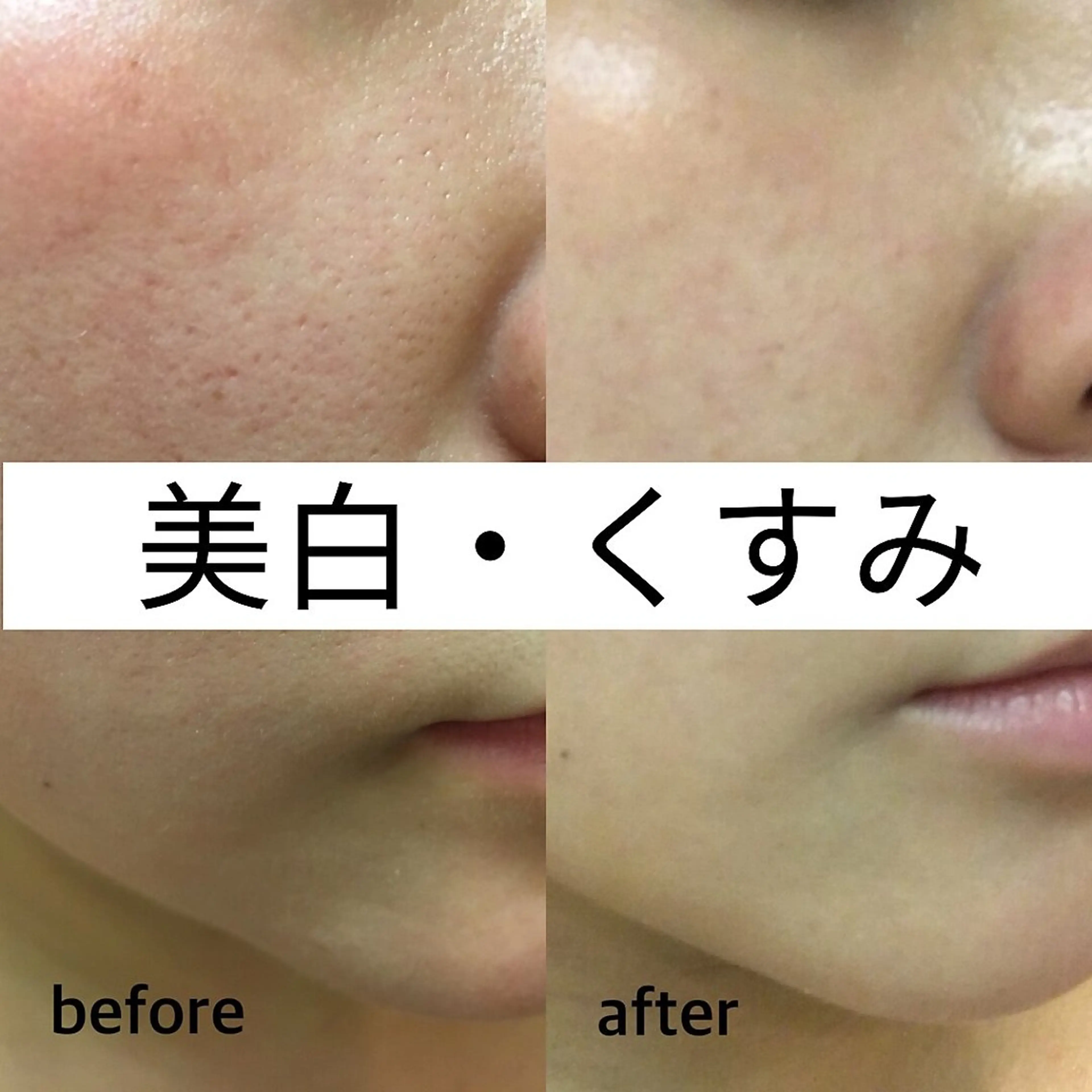 うる艶美肌【美白・くすみケア】剥けないハーブピーリング¥15,400→¥9,900(シルクパウダー)の写真