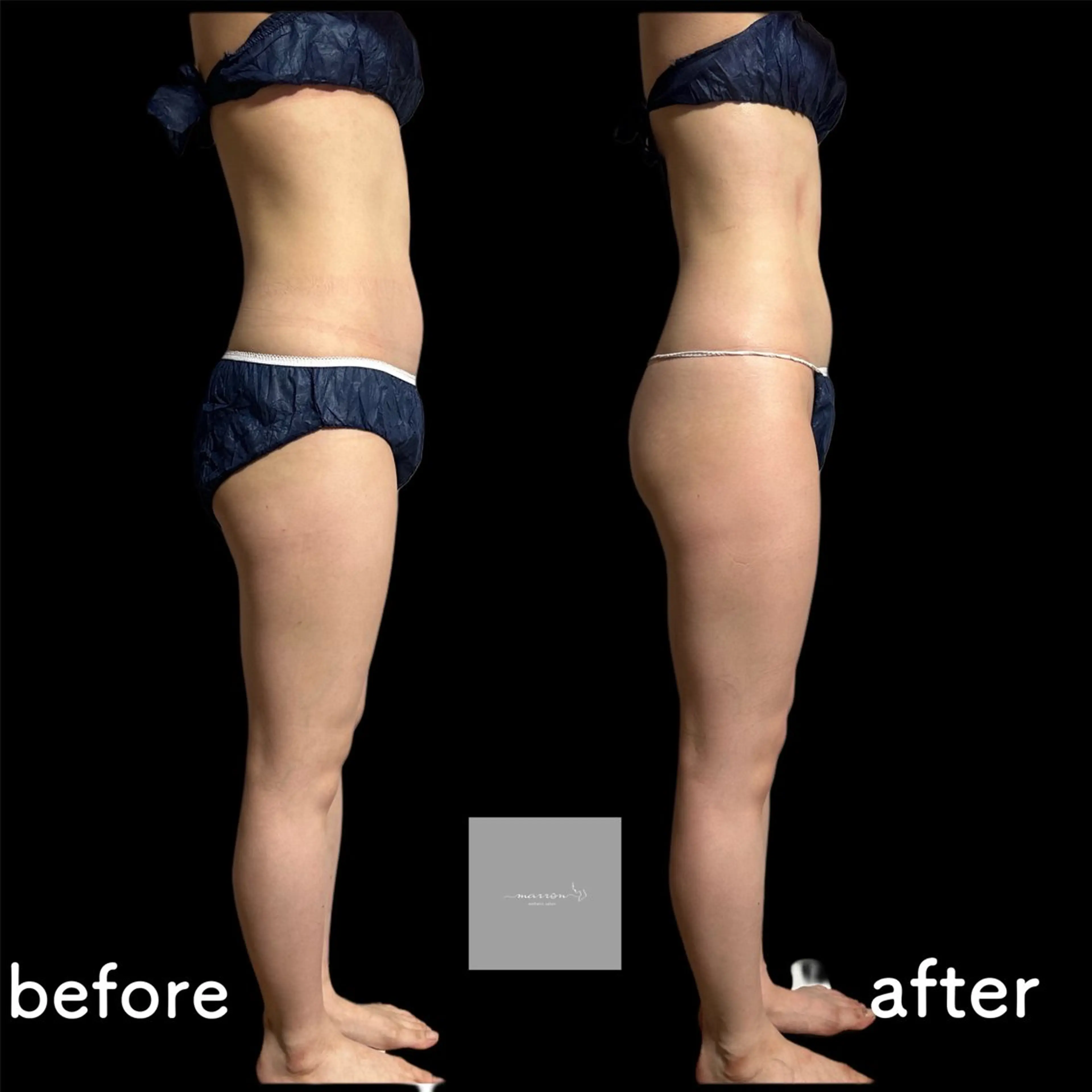 marron所属・痩身ハイパーナイフ ララピールリアボーテのエステ・リラクイメージ