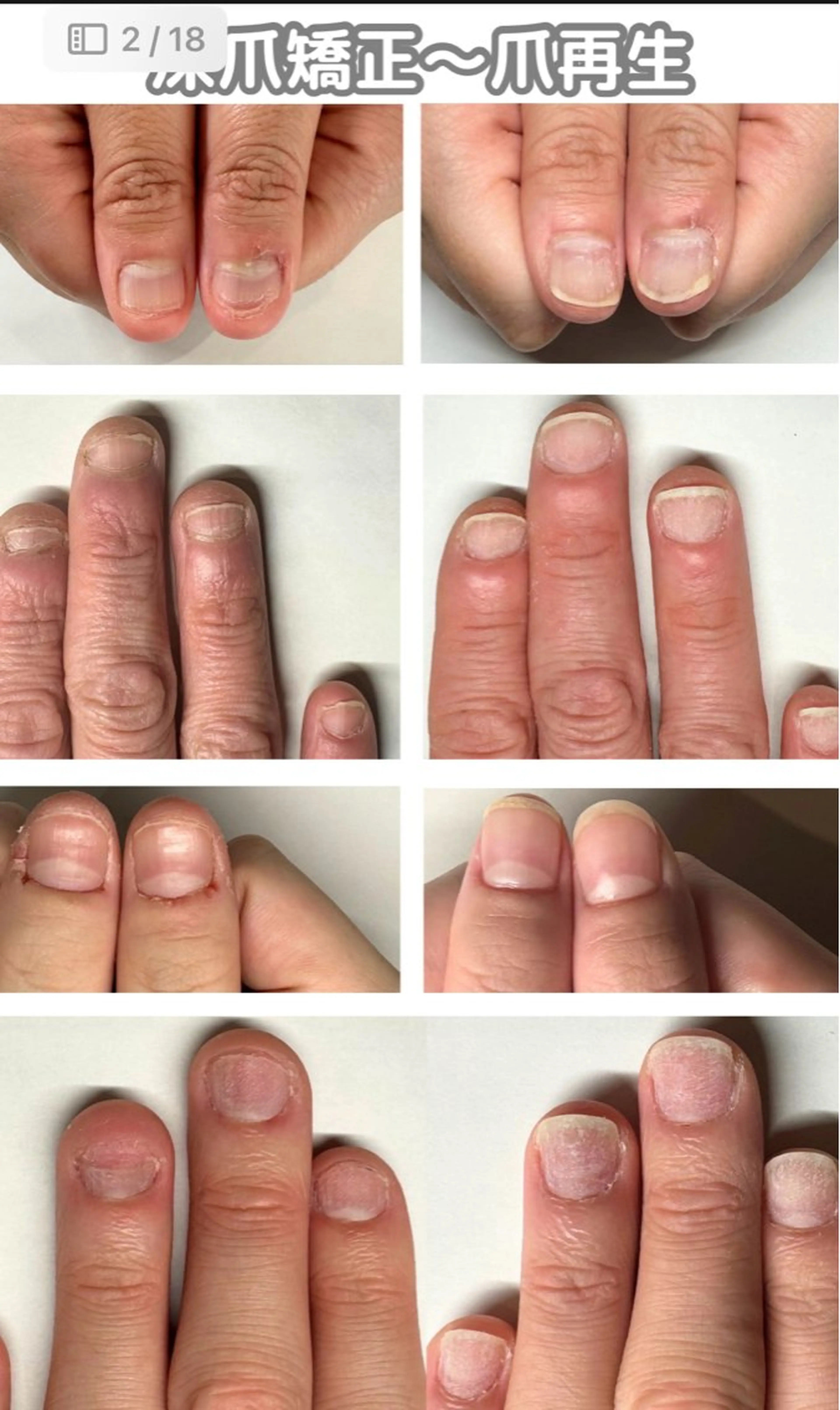 ネイル 深爪矯正専門店ネイルサロンKUU所属・ネイルサロン KUUのネイルデザイン