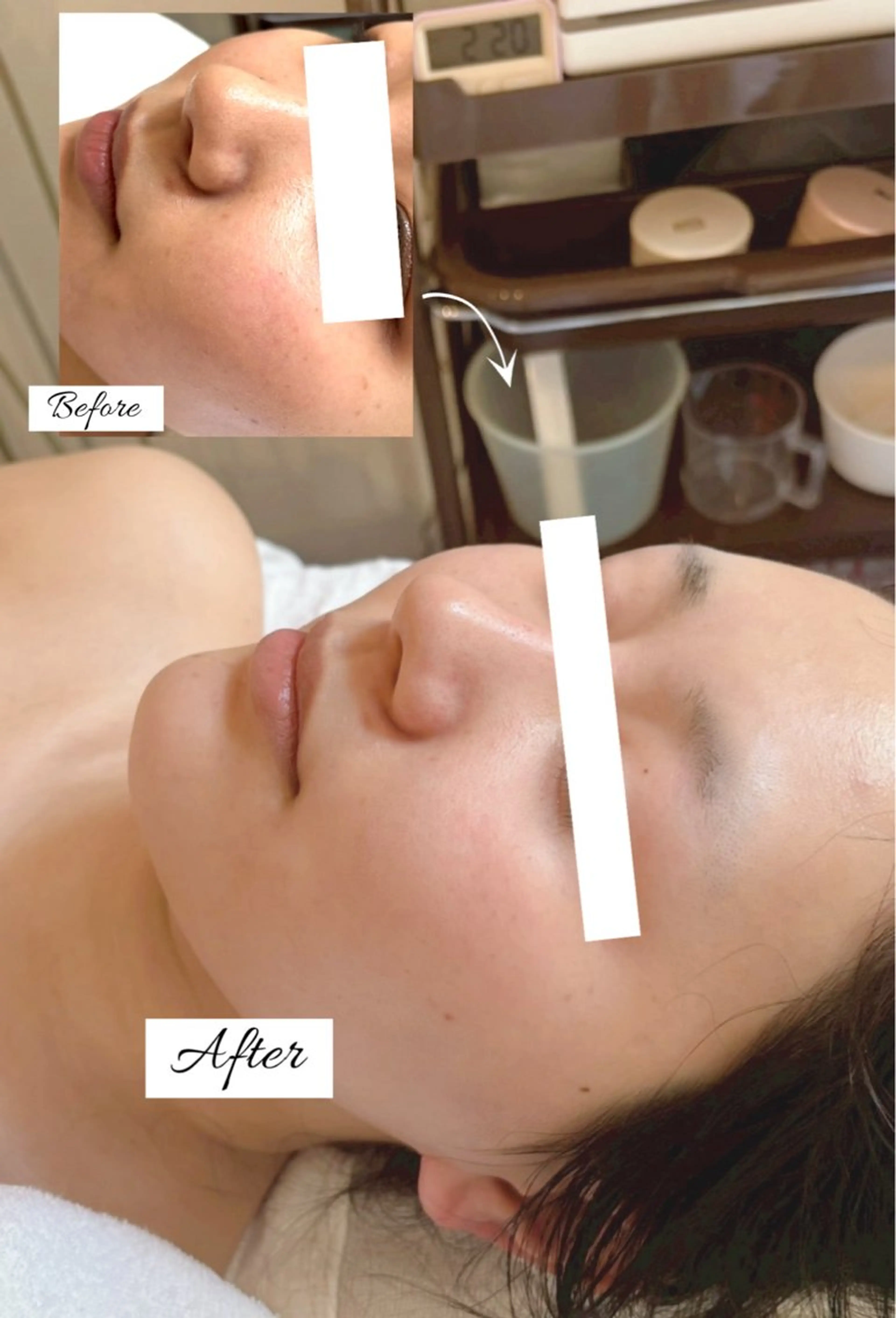 🫧フェイシャルエステ＋選べるオプション(ララピールor毛穴洗浄orヘッドマッサージ)💆‍♀️の写真