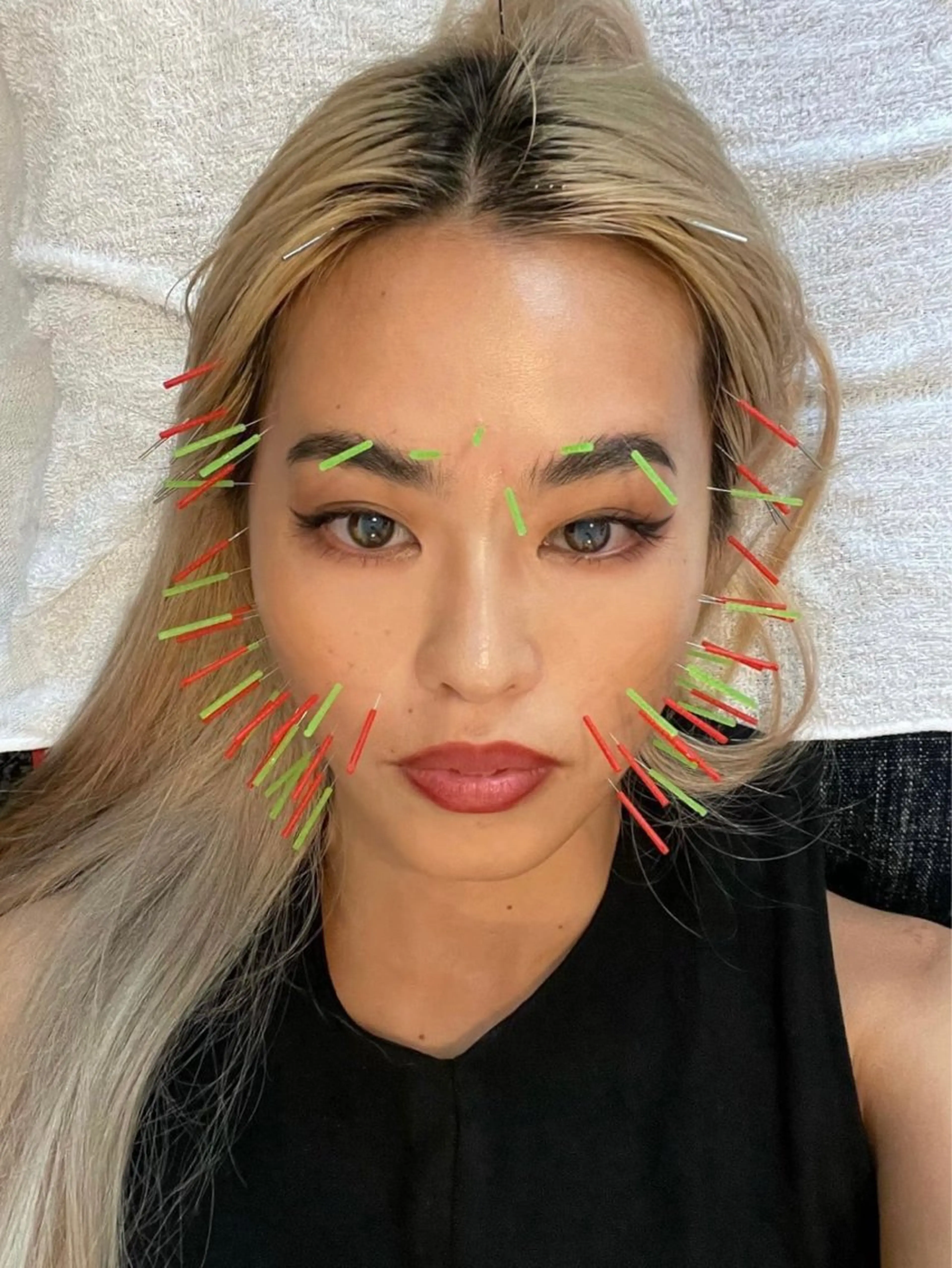 〖 人気No.１ 〗美容鍼（お顔＋頭皮）の写真