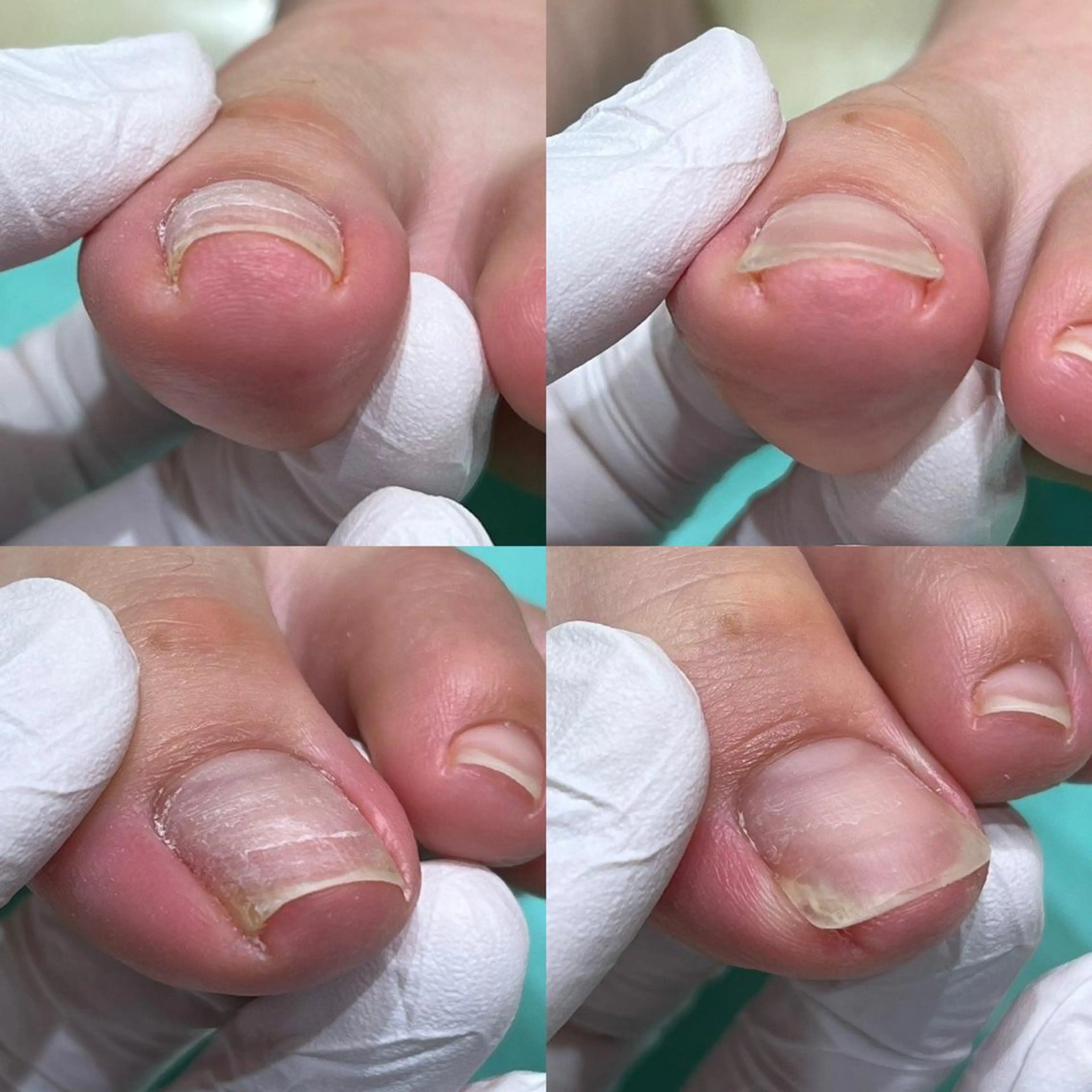 【陥入爪補正】皮膚に沈み込んだ爪も矯正器具で綺麗に補正✨生活での痛みや違和感を改善します🌈の写真