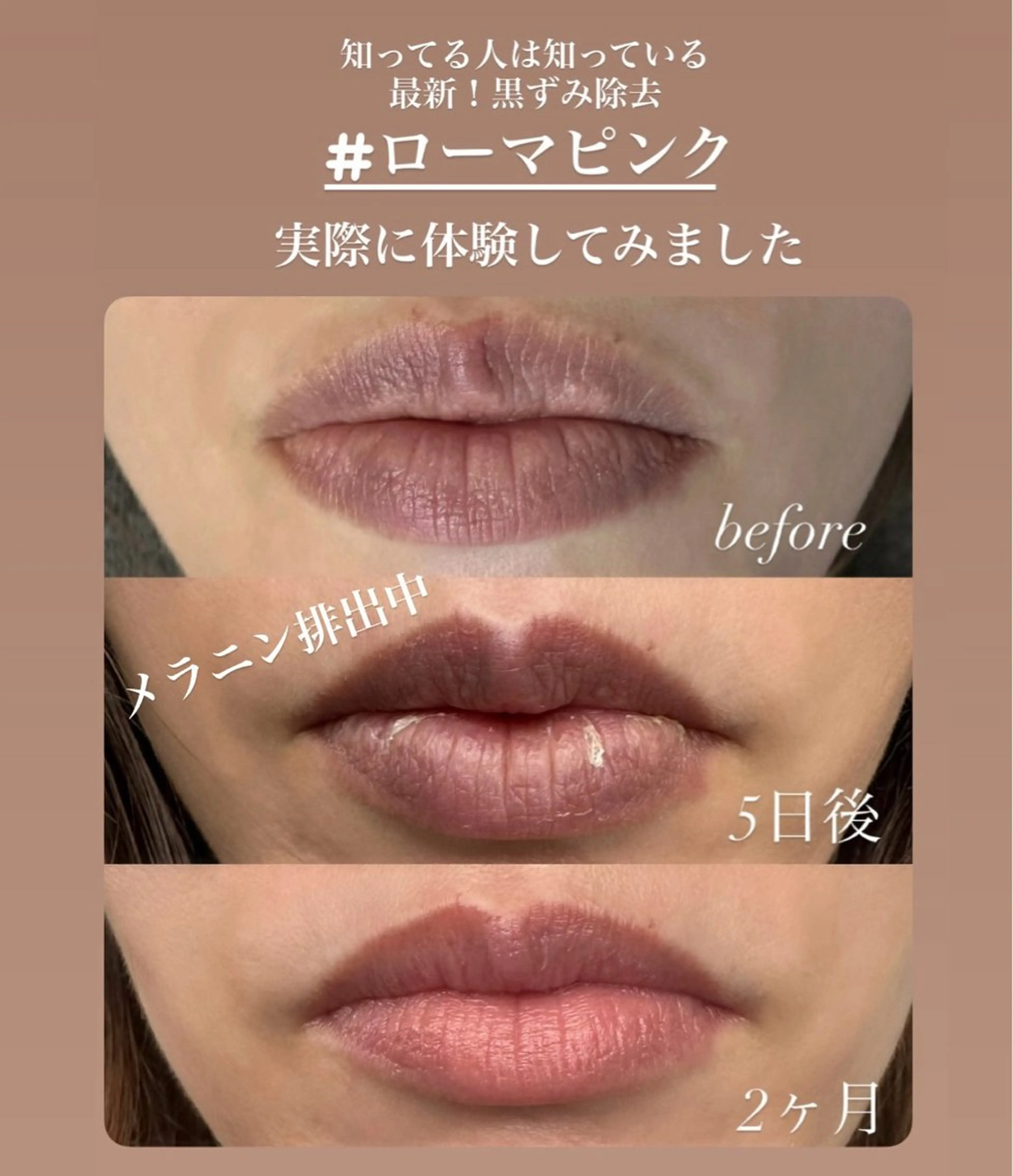 話題の最新黒ずみ除去【ローマピンク・唇】　　　　　　　　モニター募集中！！40%オフの写真