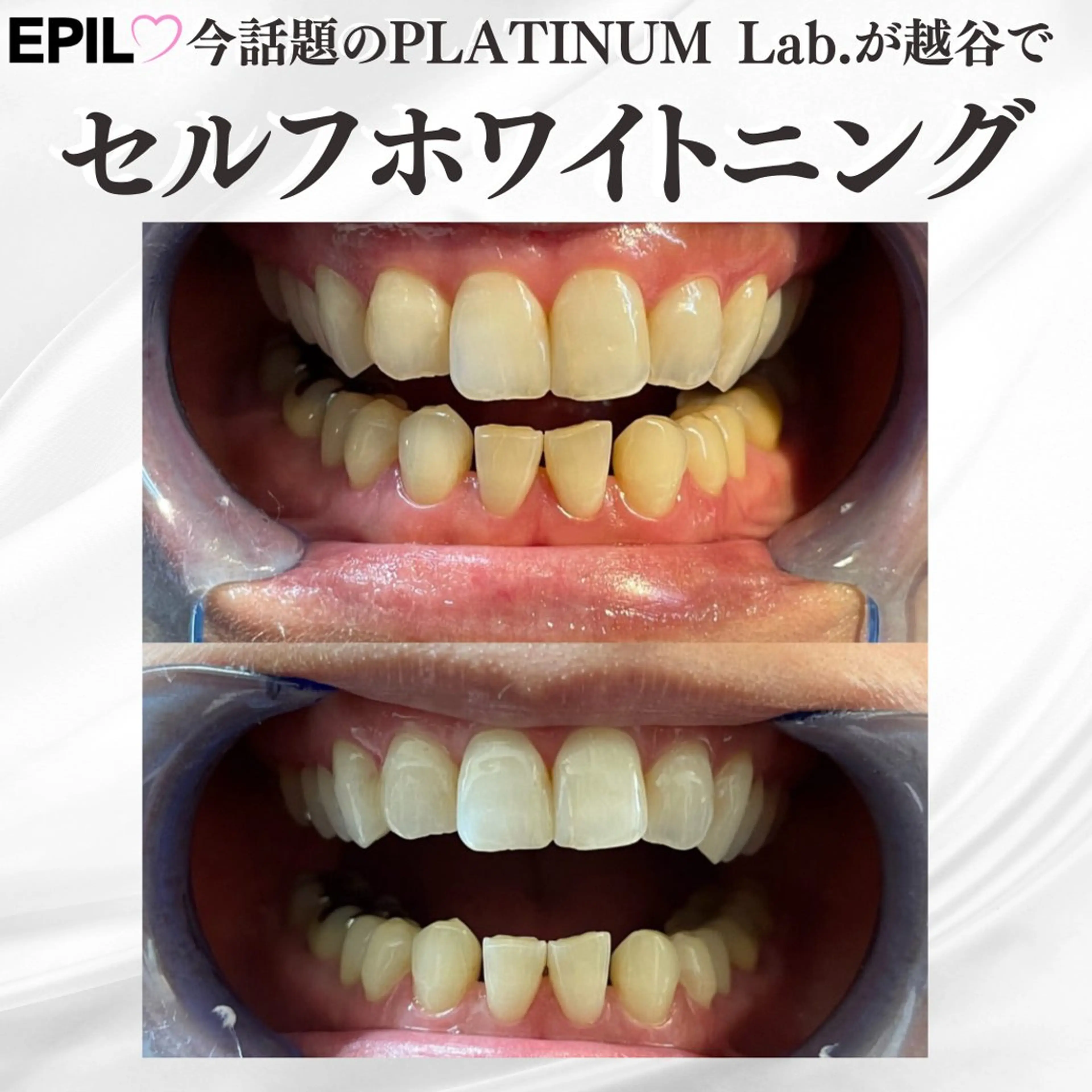 セルフホワイトニング🦷20分1照射の写真