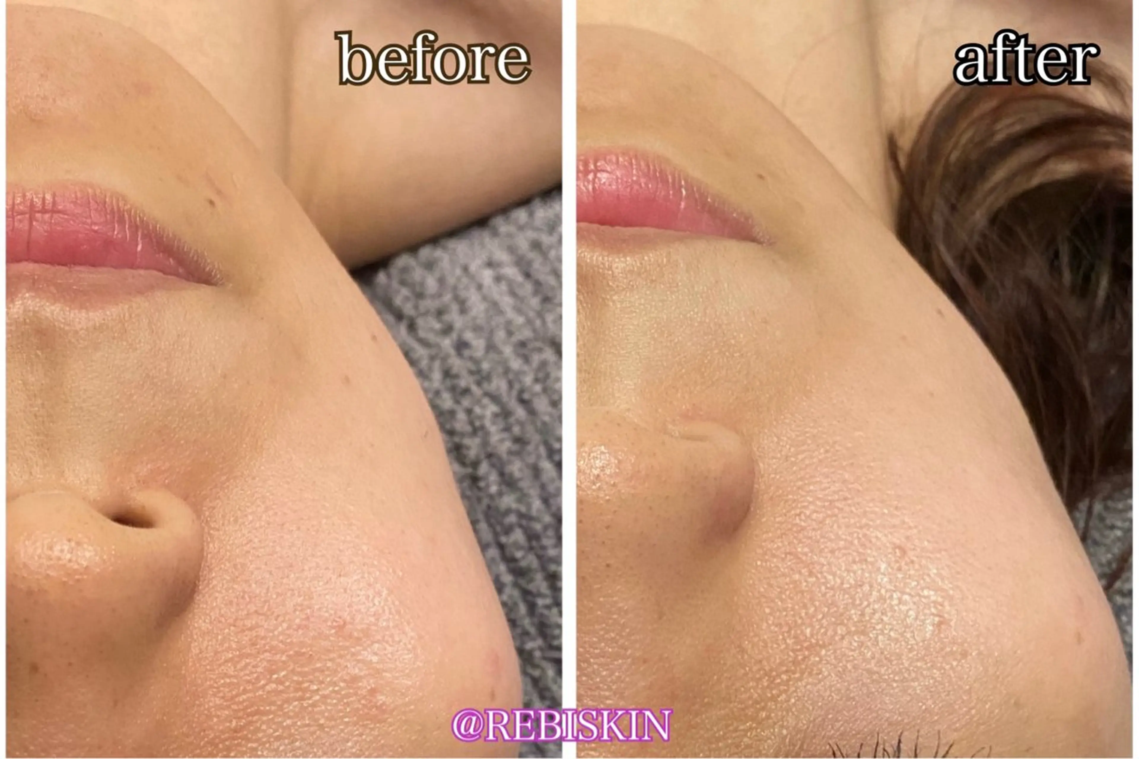 たるみ・しわ・乾燥・くすみ・脱毛効果あり【光フェイシャル💆】どんどん艶肌に⭐️口コミ投稿で次回特典あり🫶の写真