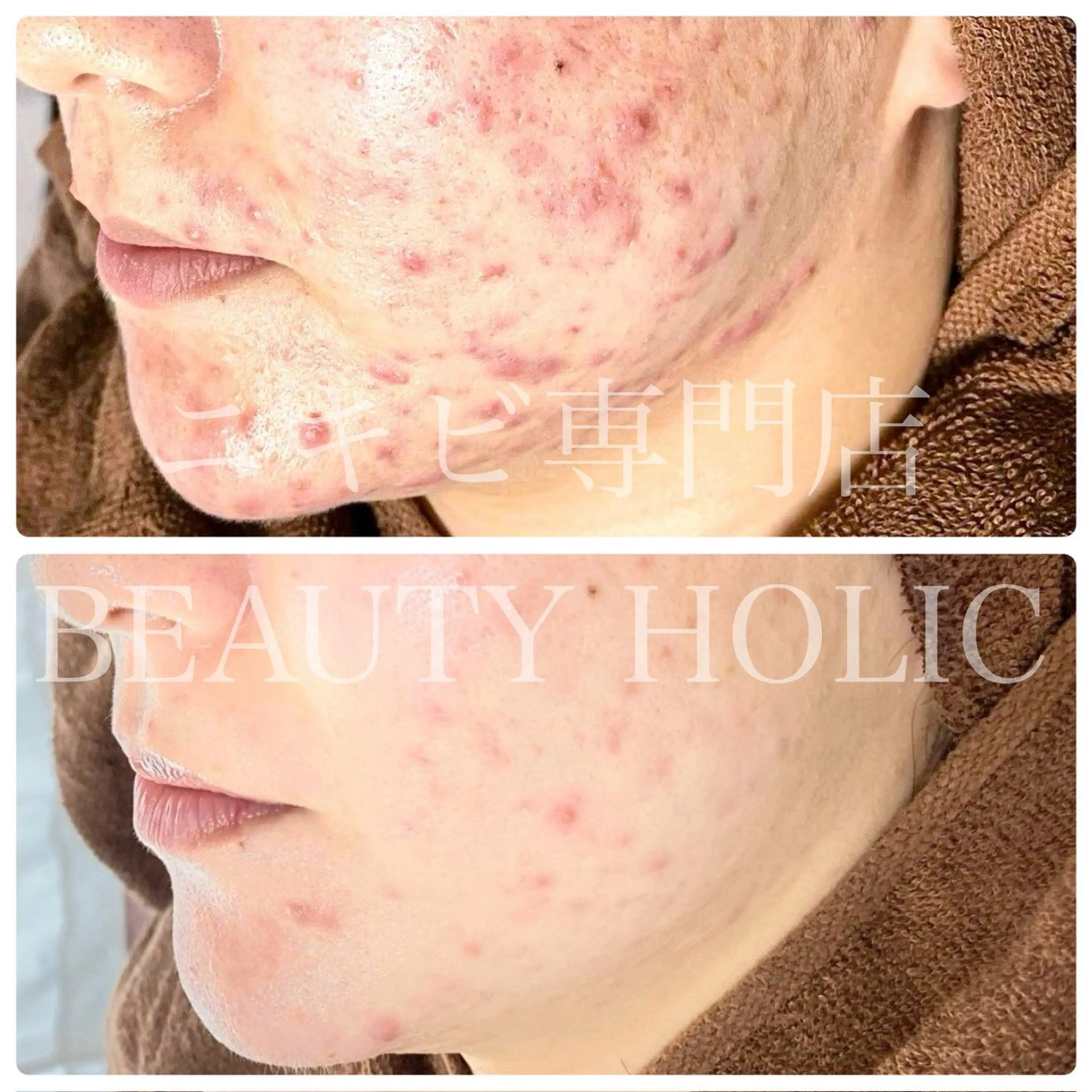 皮膚科に行っても治らなかった繰り返すニキビにお悩みの方😖もうニキビに悩みたくない‼️という方向けです✨の写真