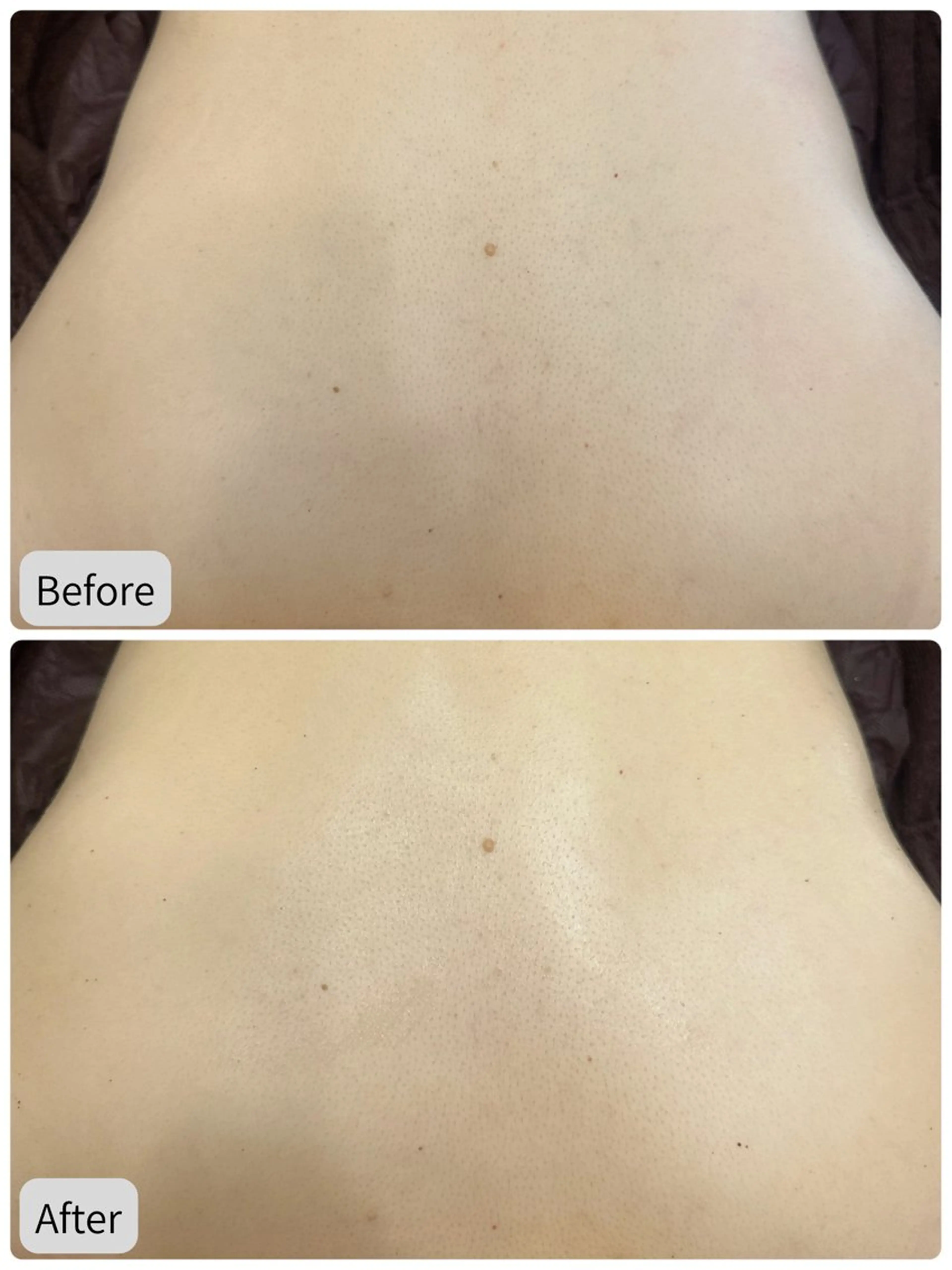 【特別価格！】背中美肌ケア★ハーブピーリングでツル肌をGETの写真