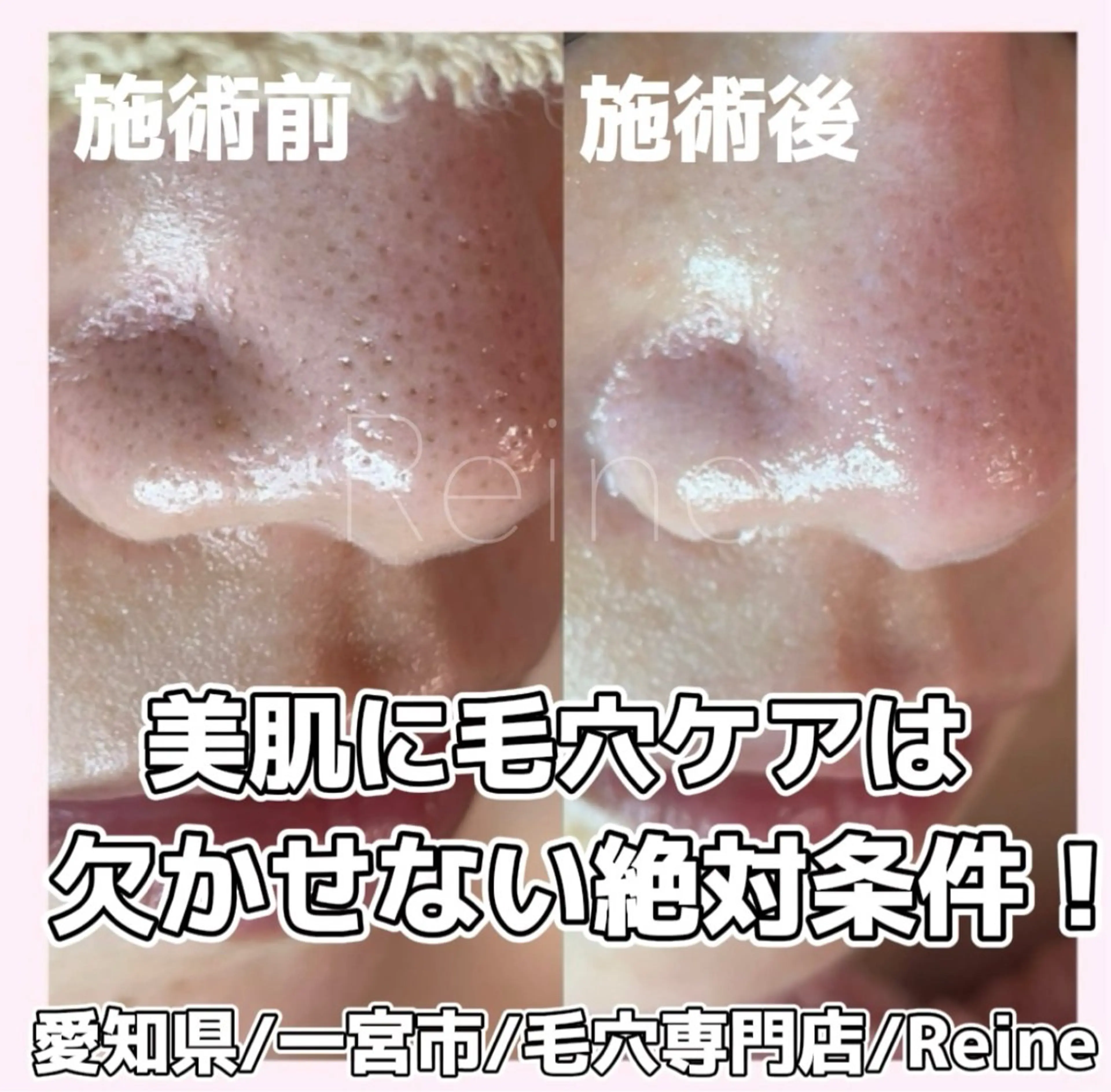 エステ Reine BeautySalon所属・毛穴/シミ肝斑/脱毛 横山梨里のエステ・リラクイメージ