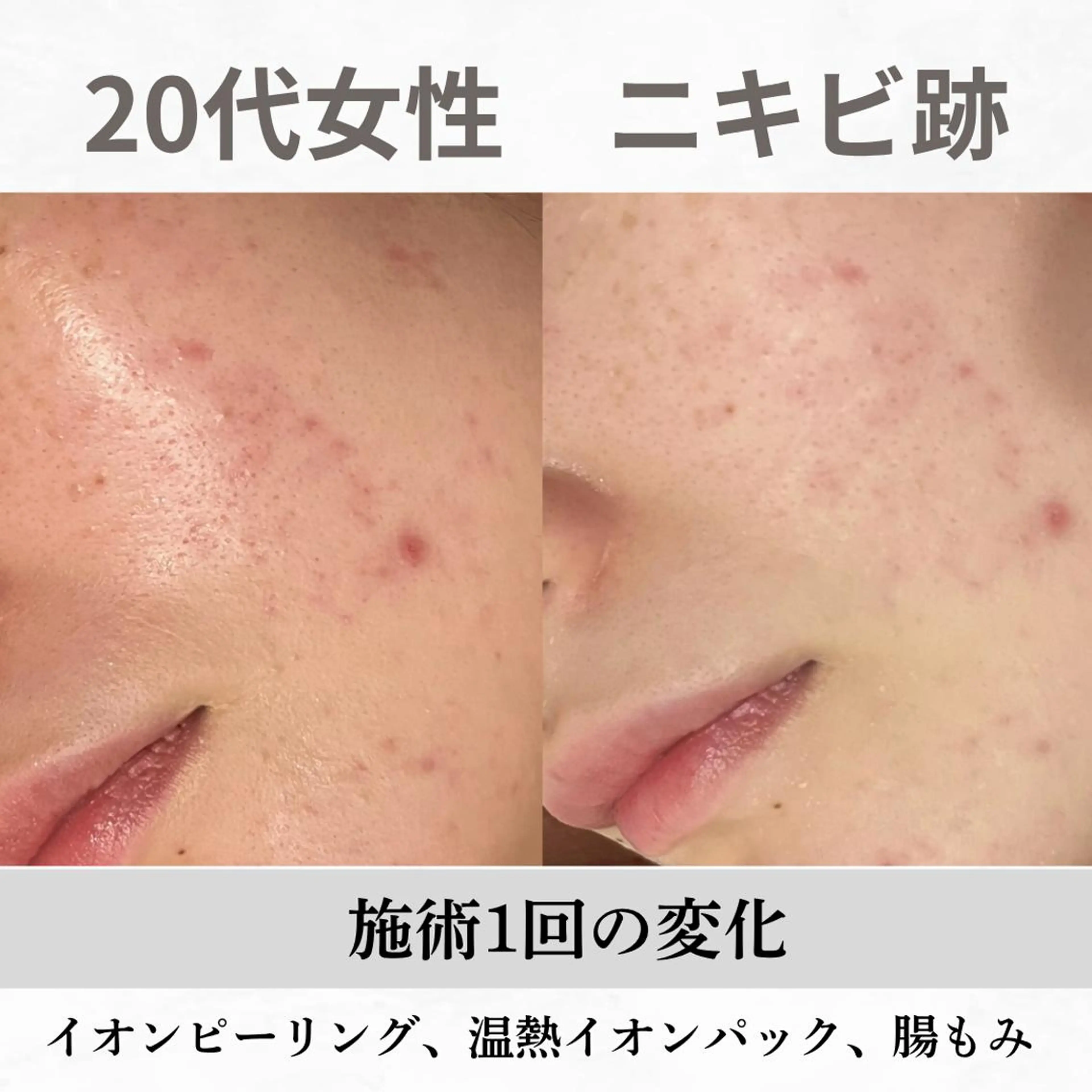 重度ニキビ専門🌷 ダウンタイムなしのエステ・リラクイメージ