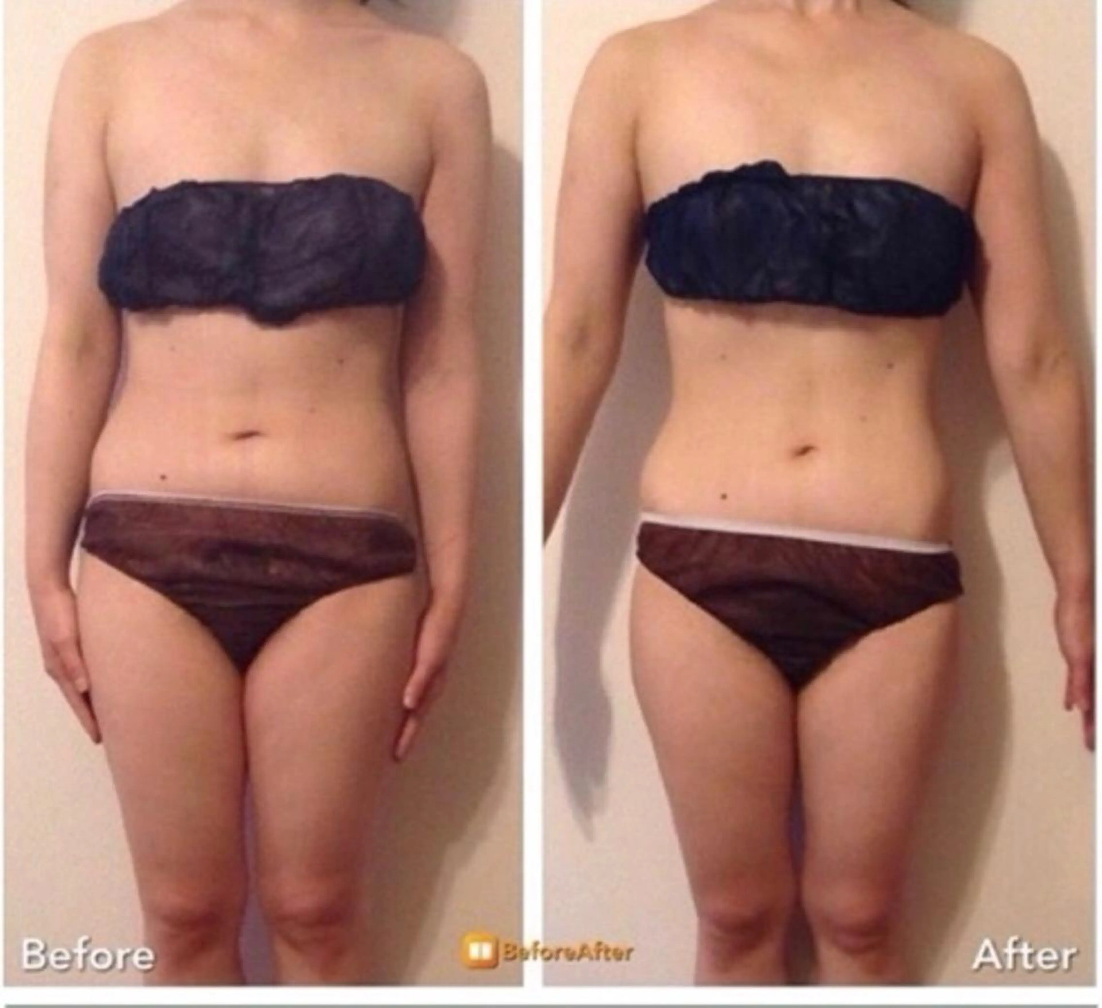 【2部位選択】キャビ&ラジオ波&リンパ70分¥16800→¥5500ダイエット!の写真