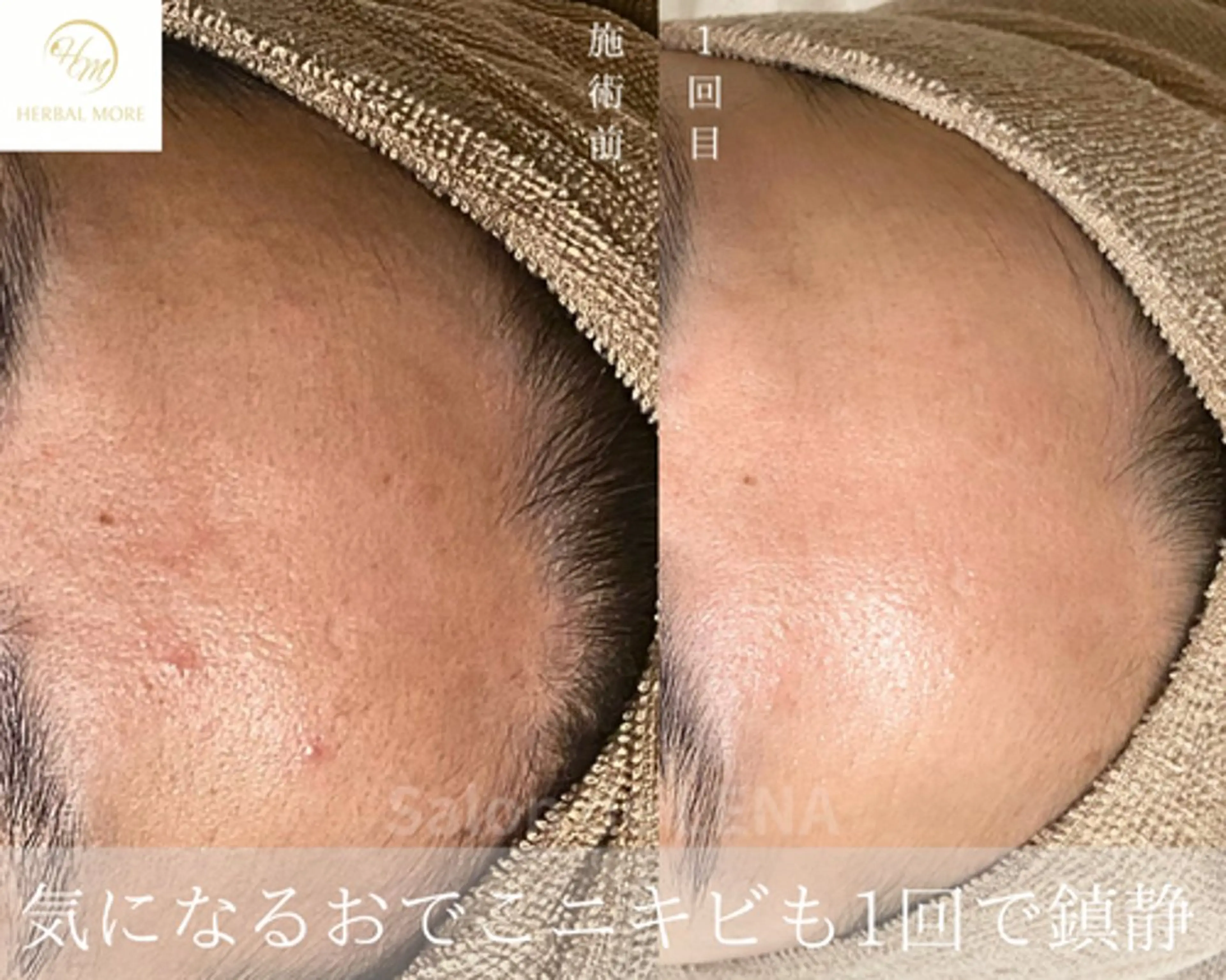 エステ サロンドレナ名駅店所属・ハーブピーリング専門 サロンドレナ平岡のエステ・リラクイメージ