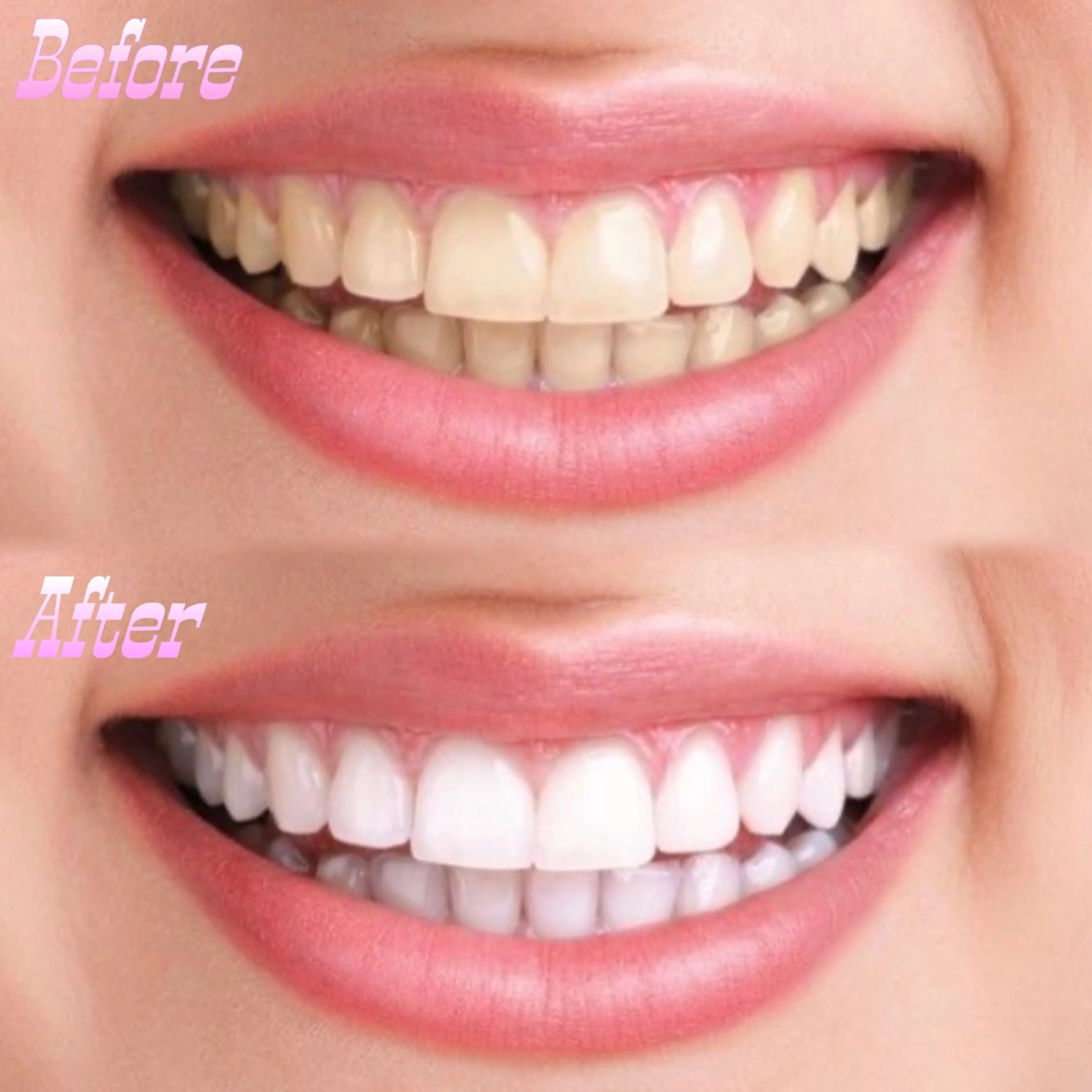 《大好評につき延長!!》大人気セルフホワイトニング3ヶ月通い放題🦷💎の写真