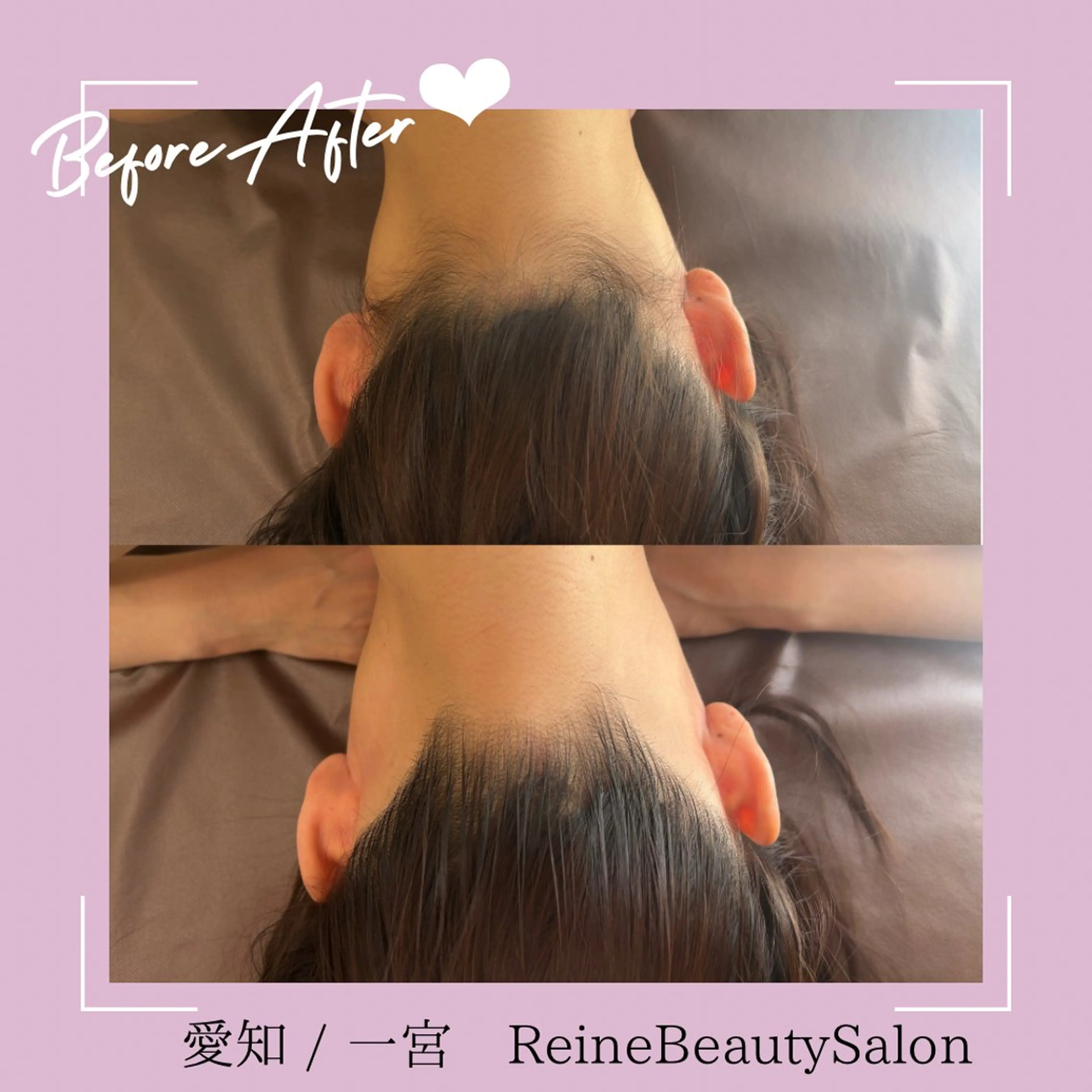 脱毛 Reine BeautySalon所属・毛穴/シミ肝斑/脱毛 横山梨里のエステ・リラクイメージ