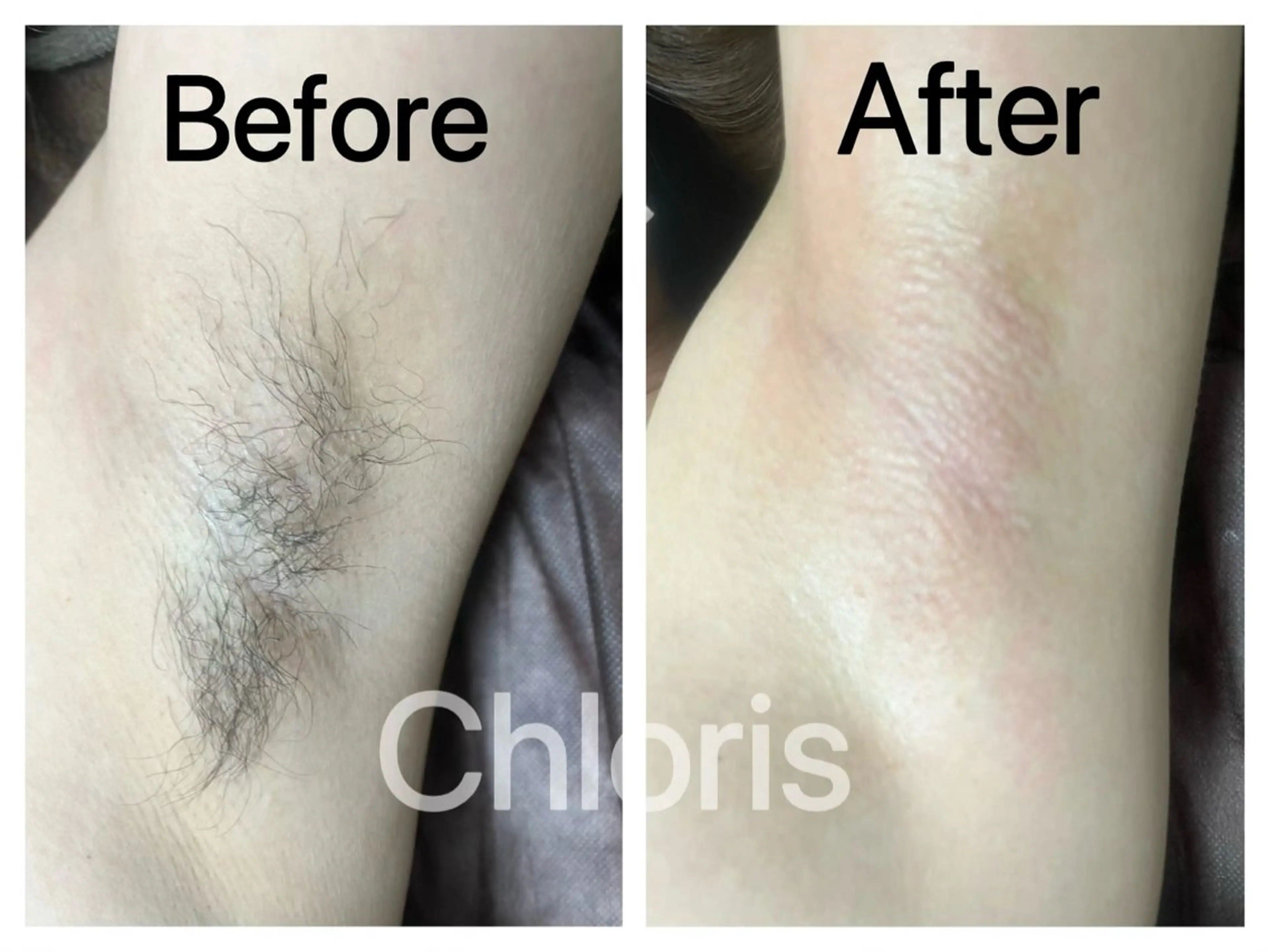 【初回限定】　【Wax脱毛】両わきケアの写真