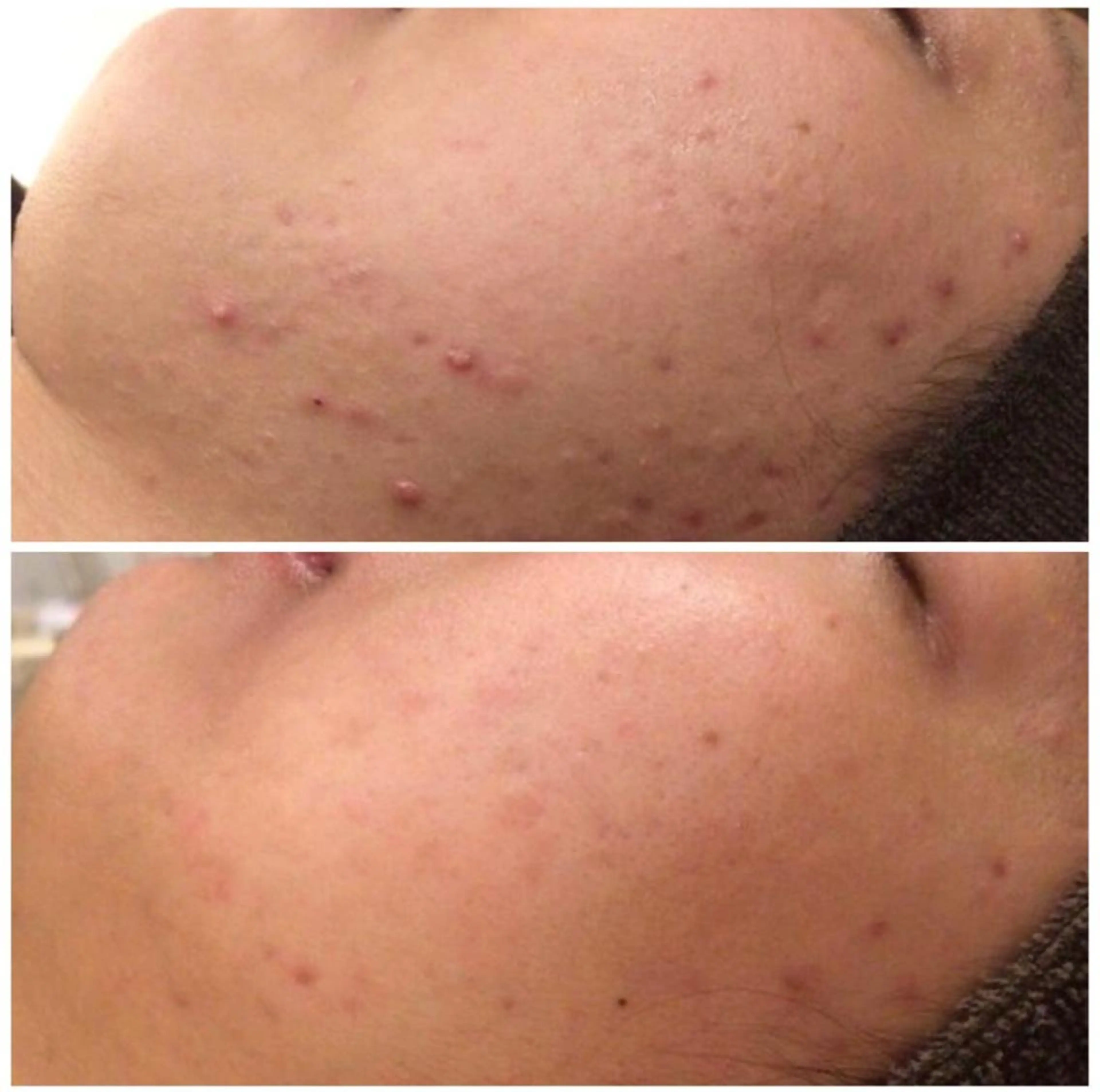 ニキビ跡改善専門🔥 医療にはできない改善のエステ・リラクイメージ