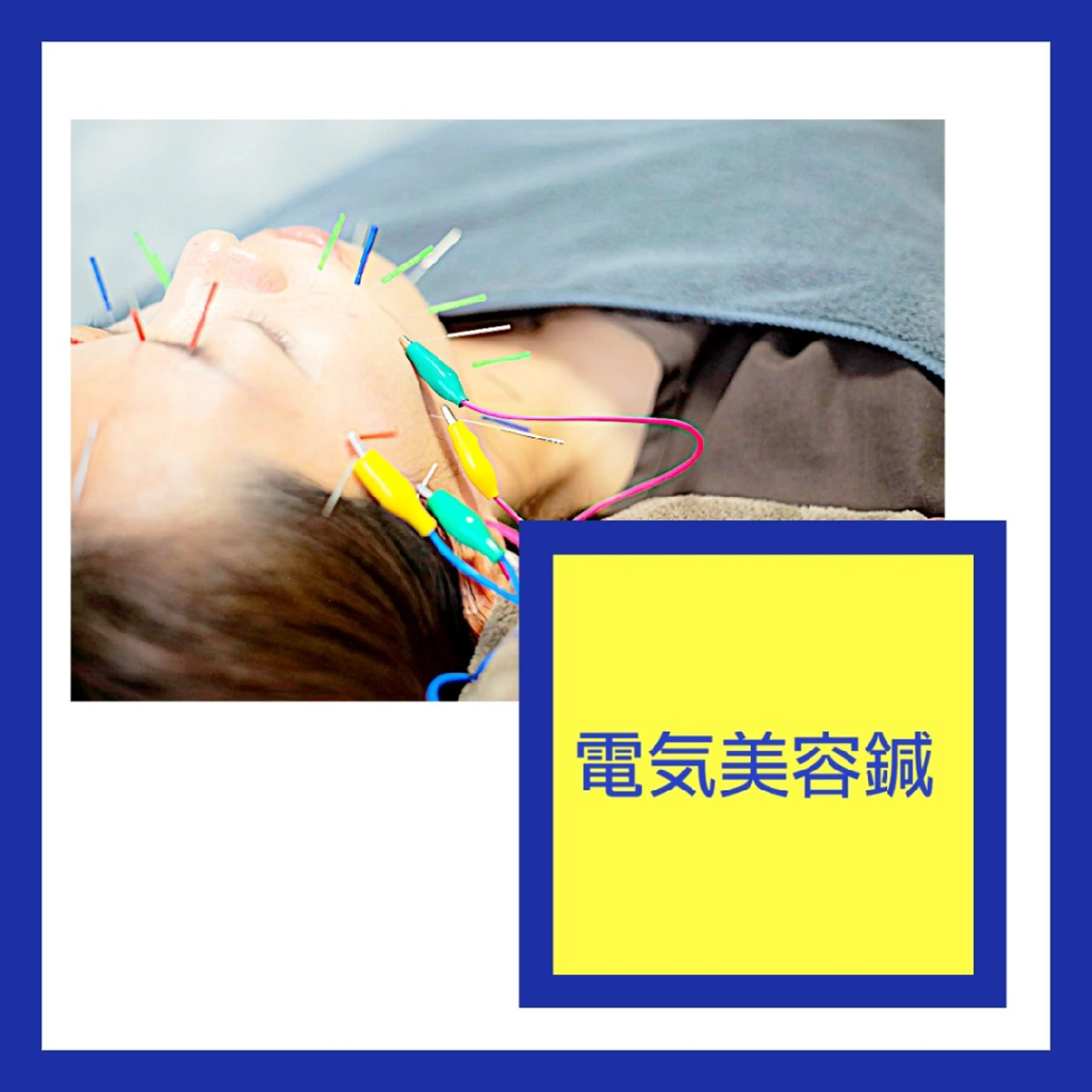 ダルダルにたるんだフェイスラインがきゅっと上がる【たるみ特化 電気美容鍼】初回お試しの写真