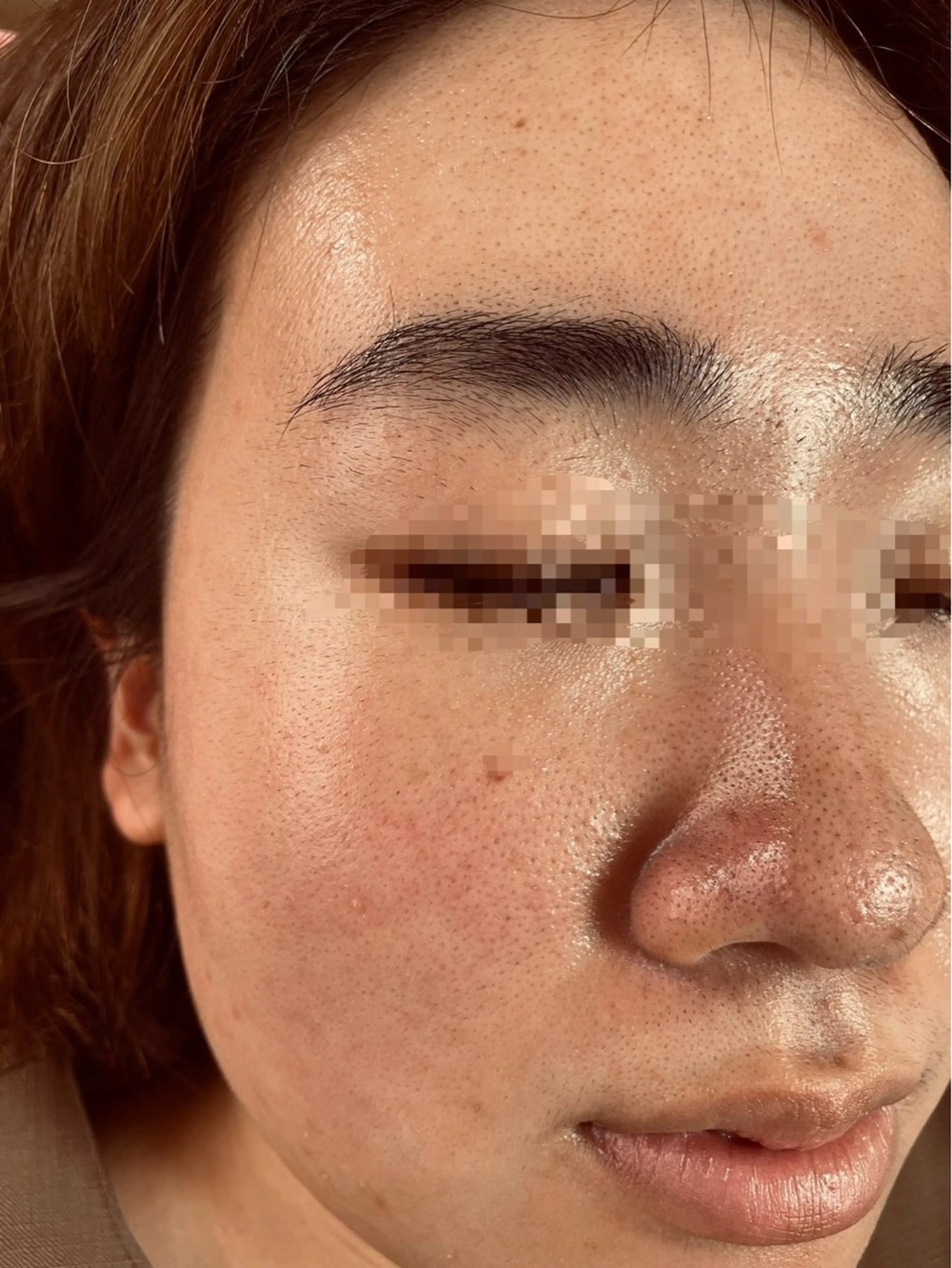 《年末のセール》企画✨顔全体毛穴洗浄とピールオフパック付き☺️の写真