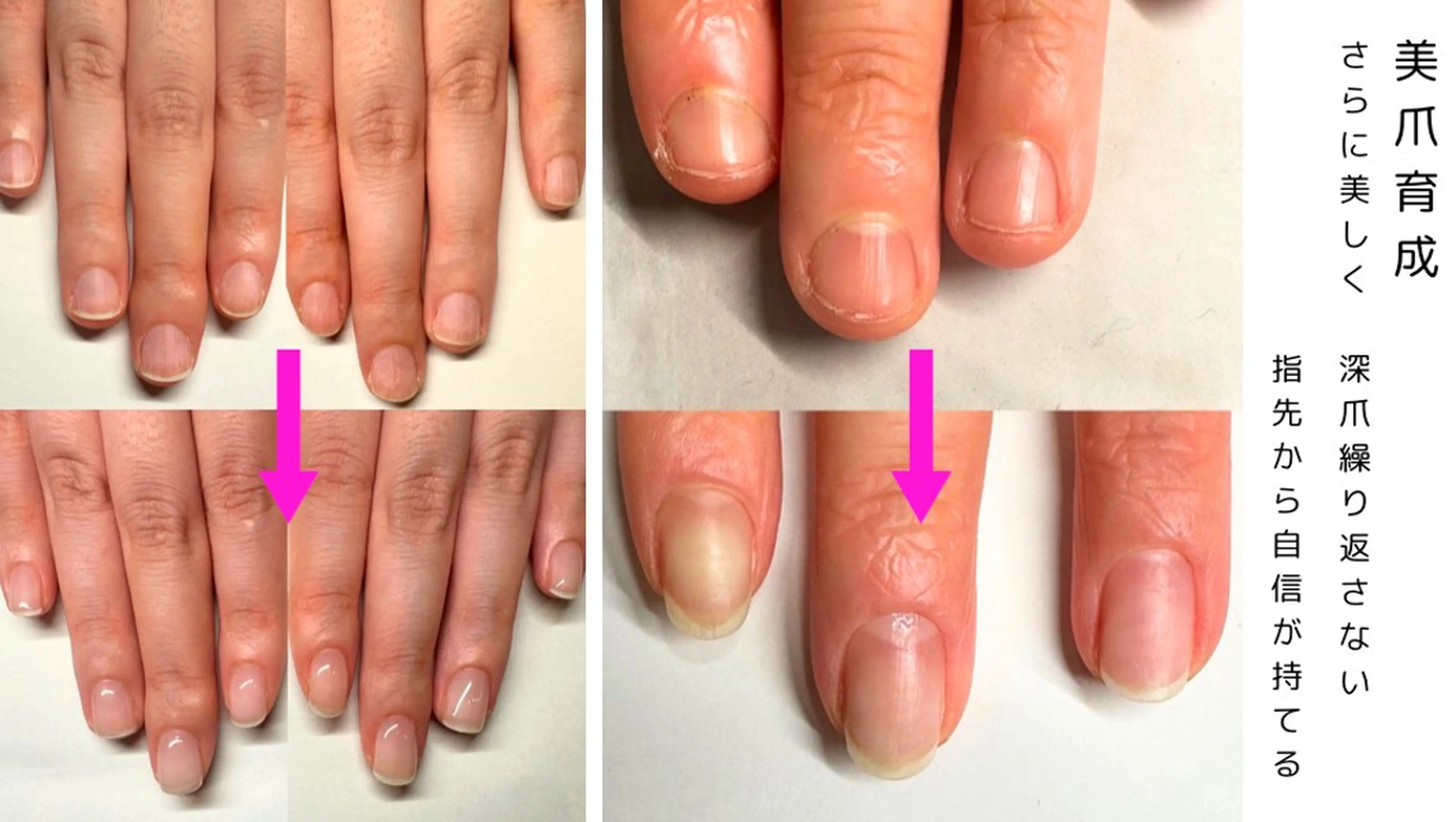 ネイル 深爪矯正専門店ネイルサロンKUU所属・深爪矯正専門店 ネイルサロンKUUのネイルデザイン