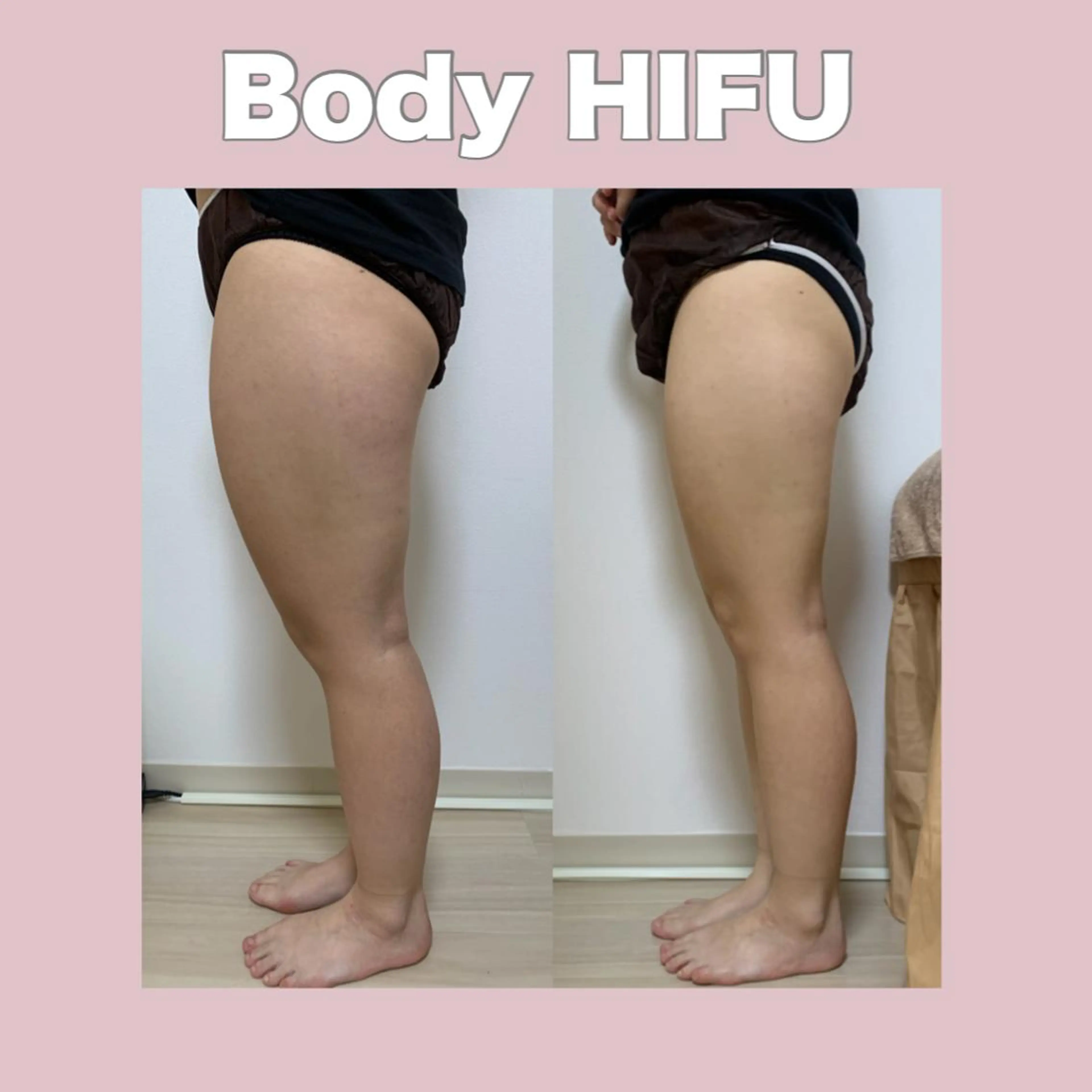 痩身マシンボディ　15000shotの写真