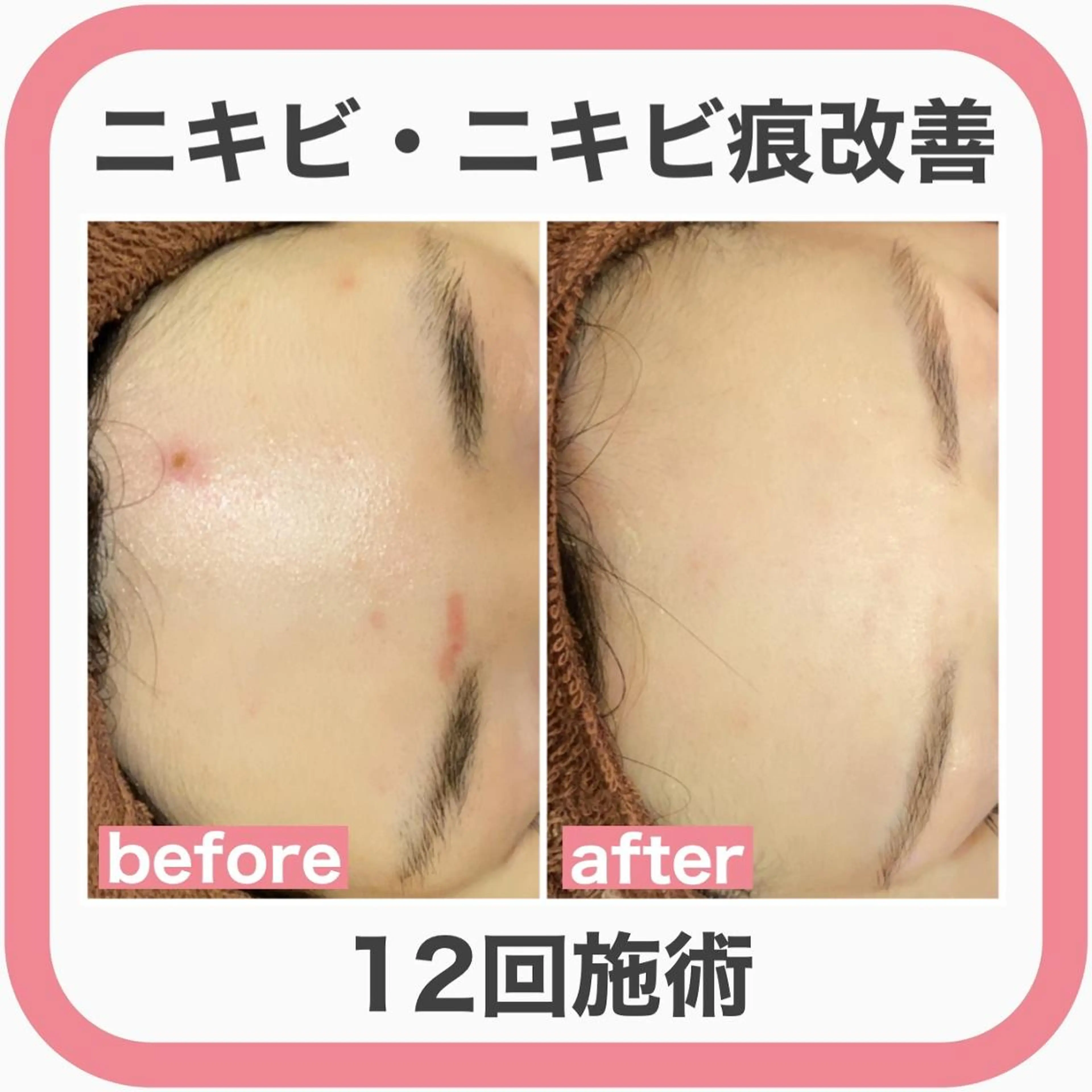 ニキビ特化型エステ 🍓最短で肌質改善のエステ・リラクイメージ