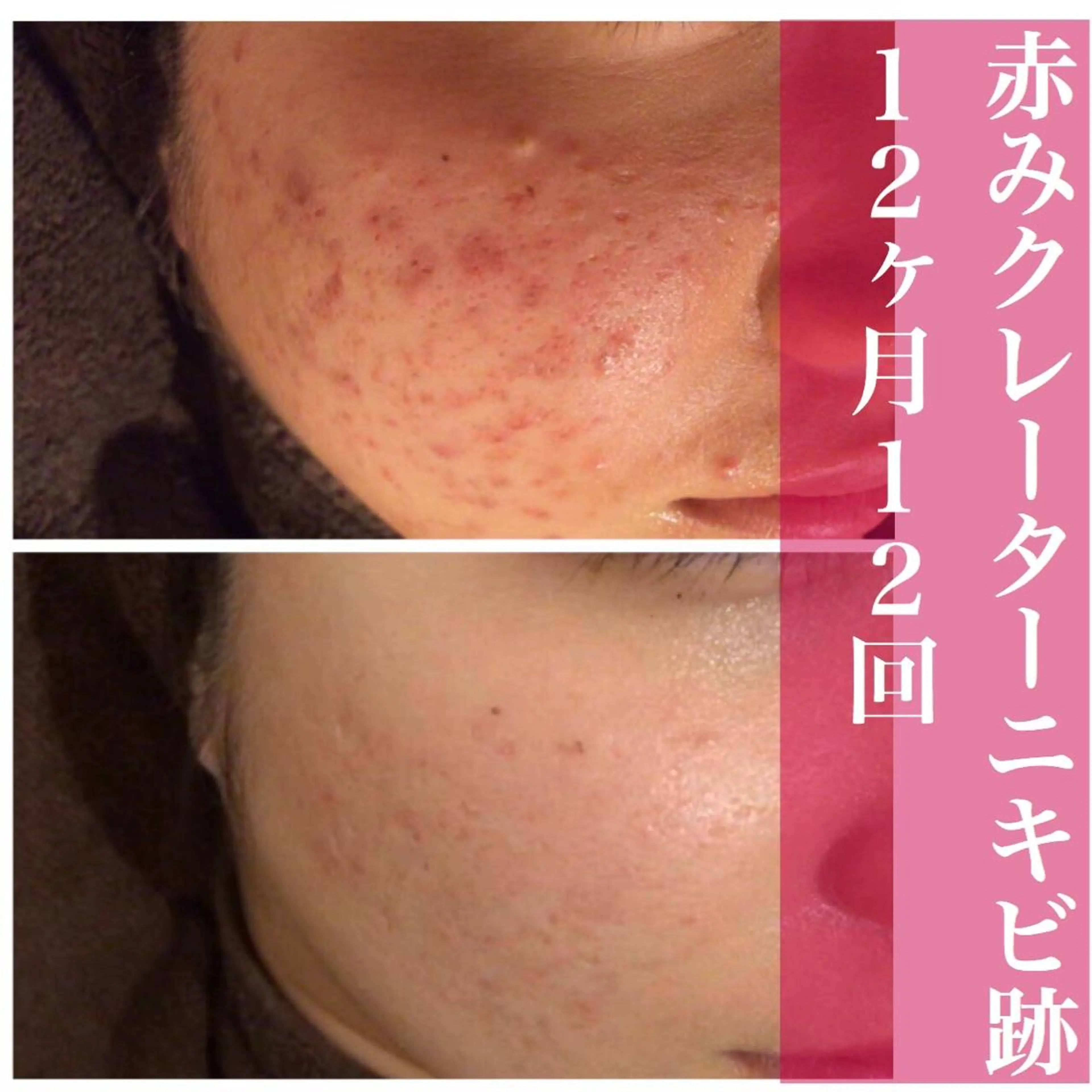 ミディアム パーマ メンズ キッズ ネイル マツエク・マツパ アイブロウ ニキビ・肌質改善専門 ♡人生が変わるサロンのエステ・リラクイメージ