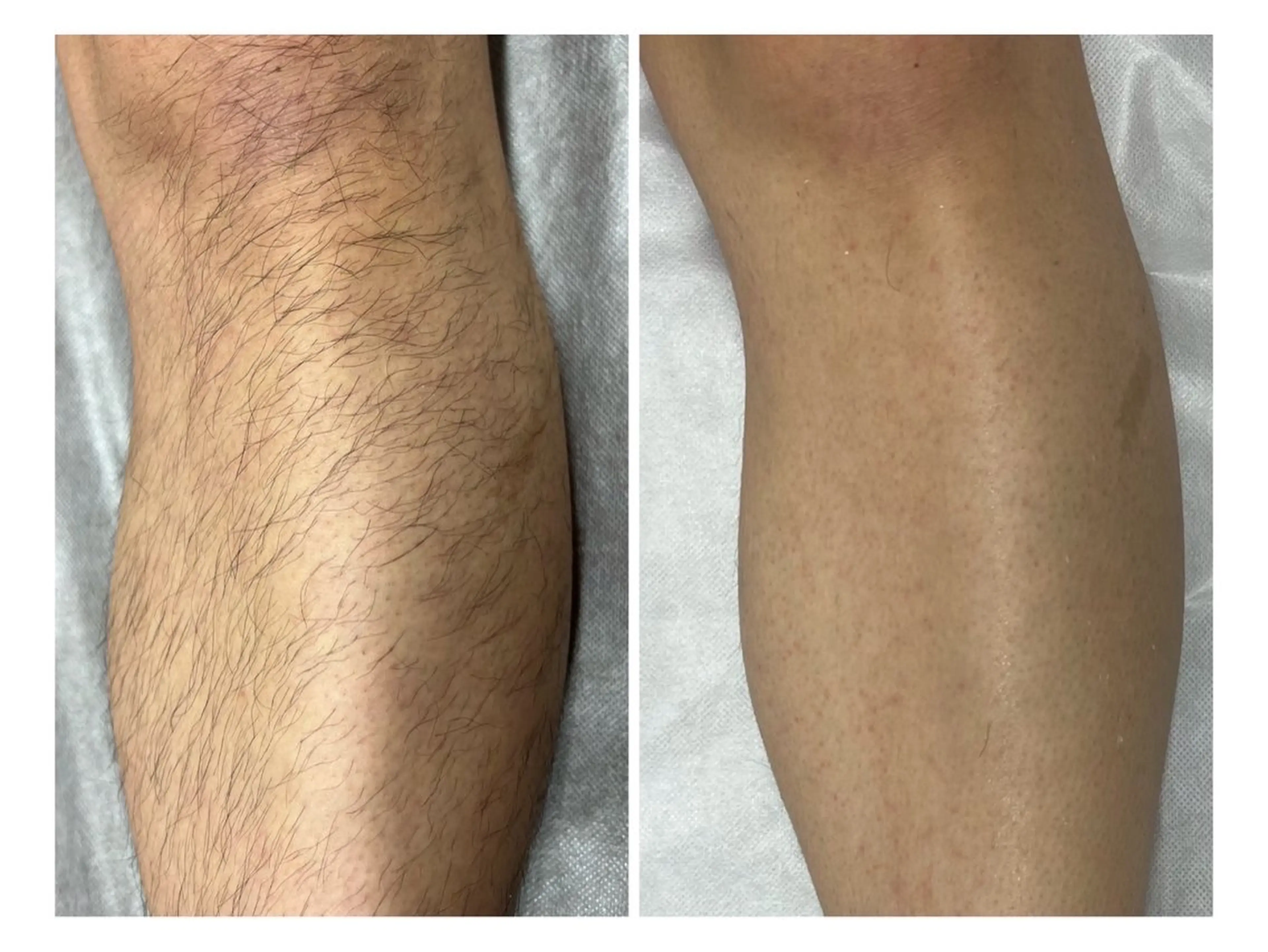 【新規男性/初めての脱毛で迷ったらこれ！】ひげ込VIO無全身脱毛体験¥11000の写真