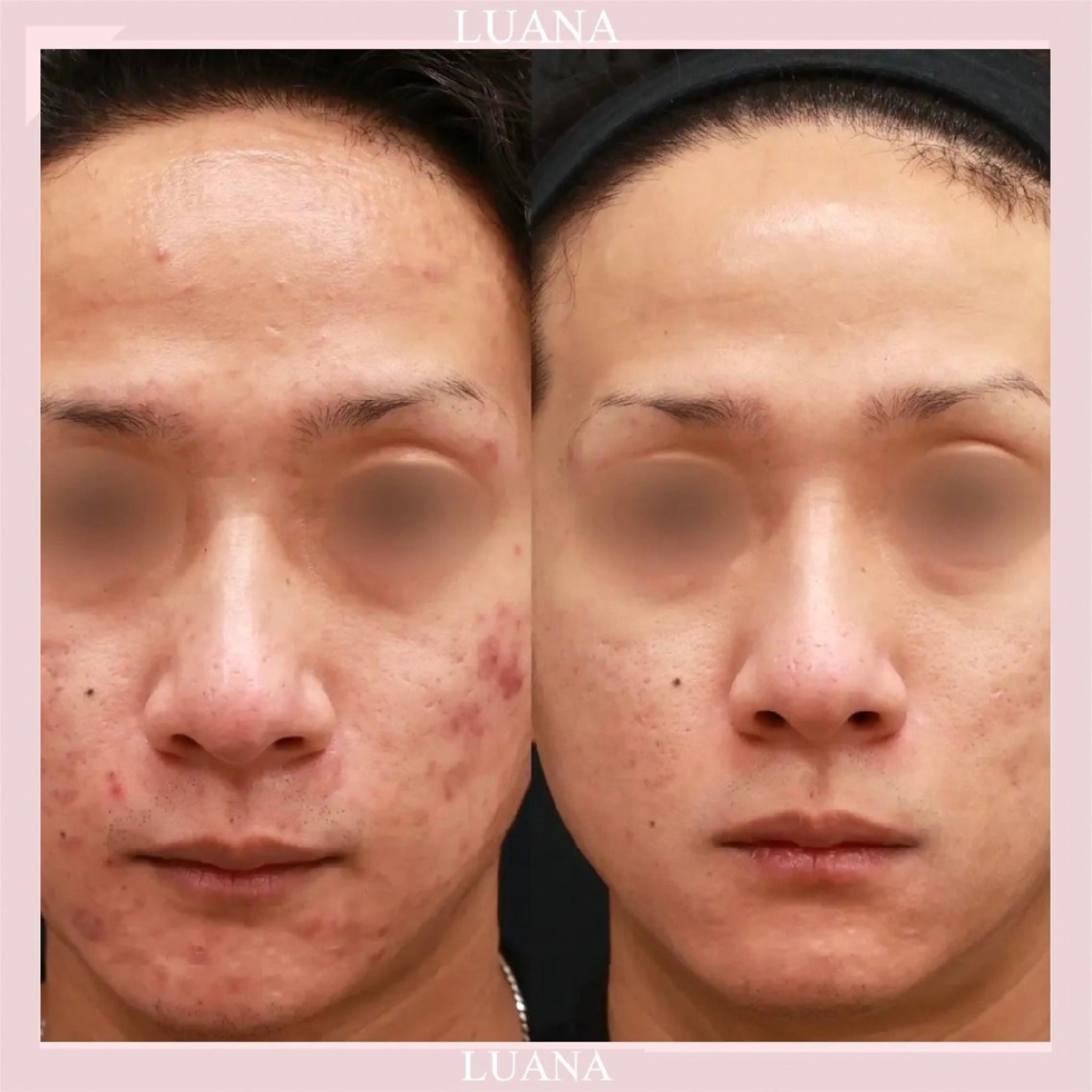 エステ 脱毛・小顔専門サロンLUANA所属・脱毛&シェービング 専門店 平岡のその他イメージ