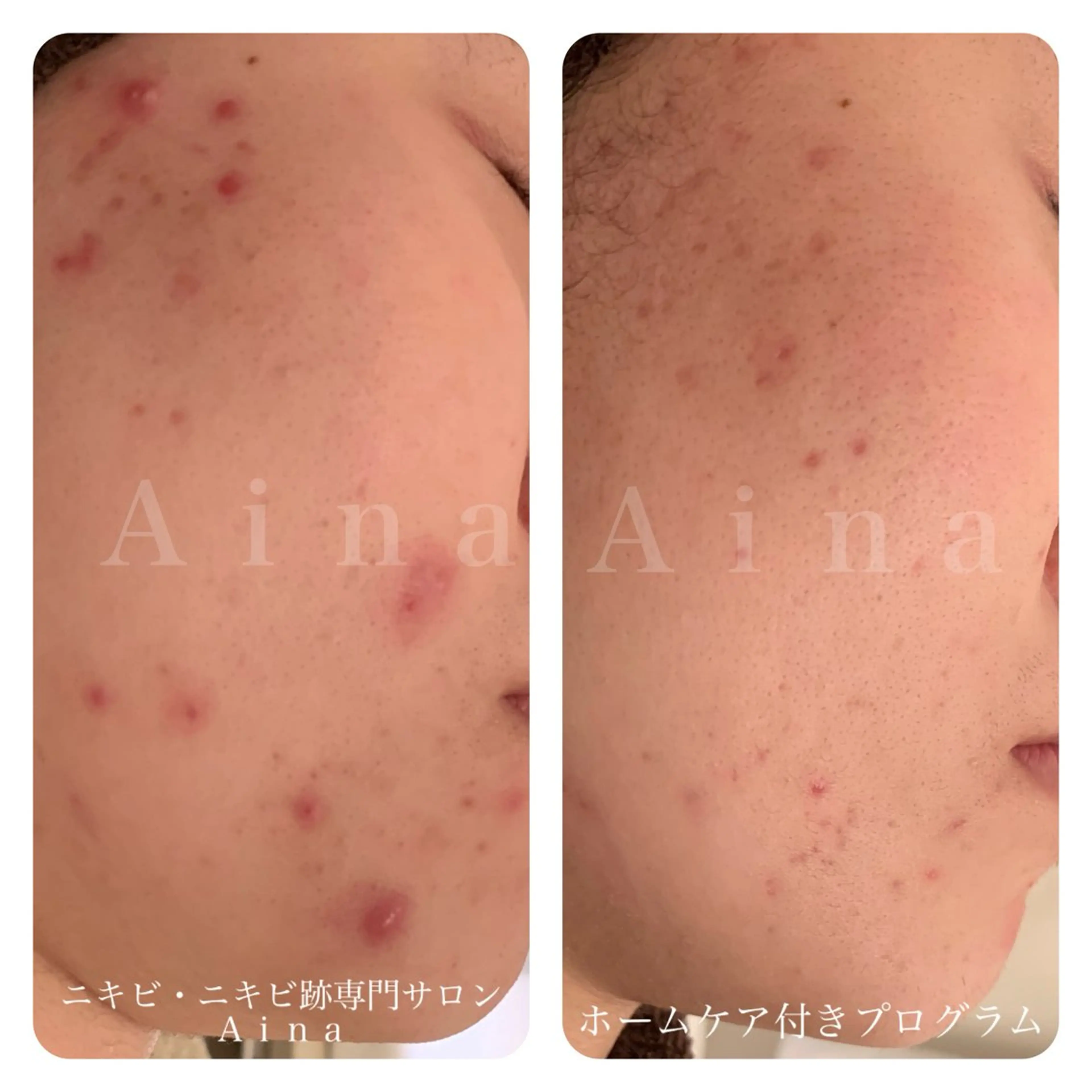 エステ リラク ニキビ跡専門サロン Ainaのエステ・リラクイメージ