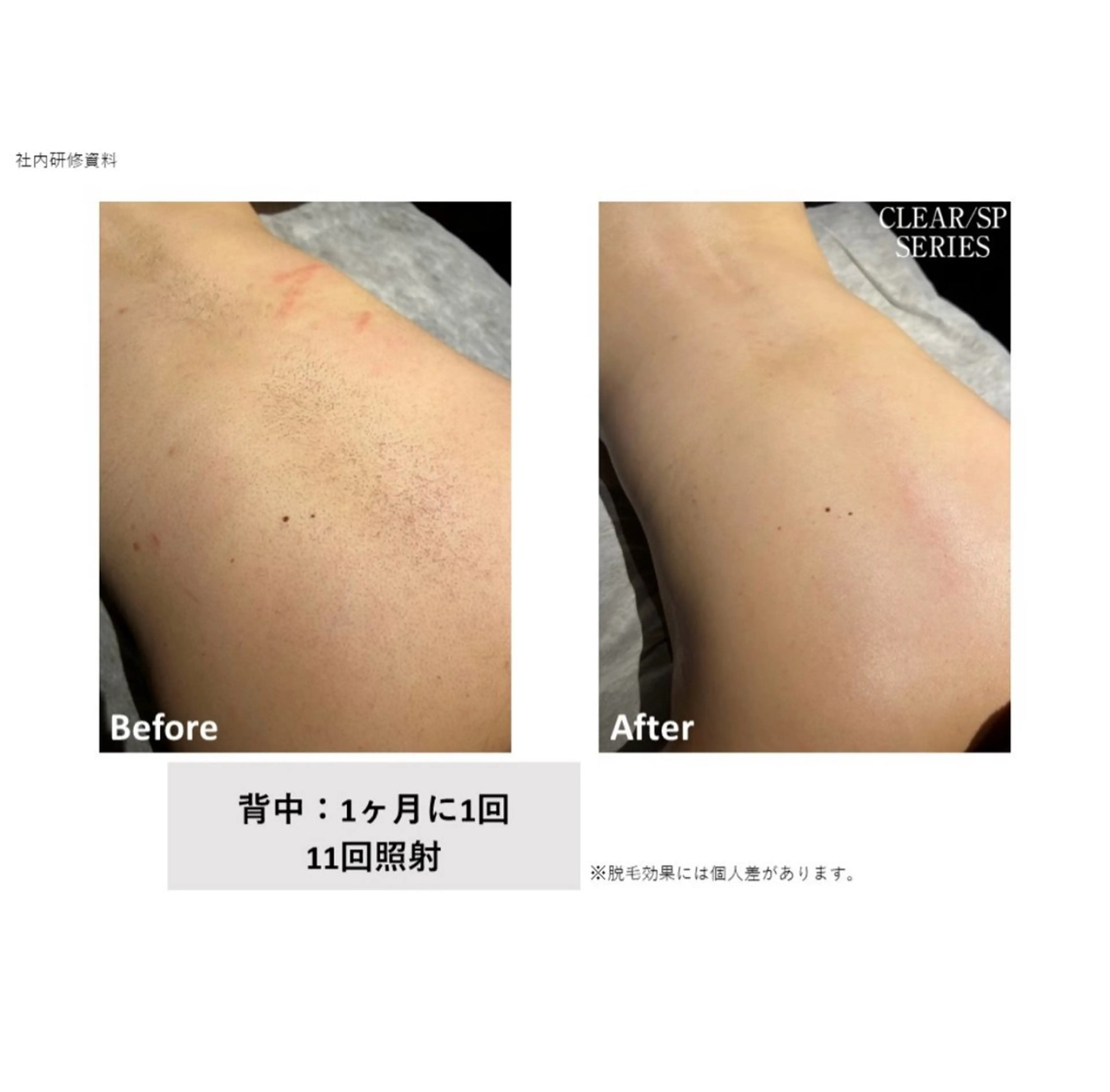 ポツポツ ザラザラ👋背中ケア《脱毛orニキビケアorシミ光ケア》🫧の写真