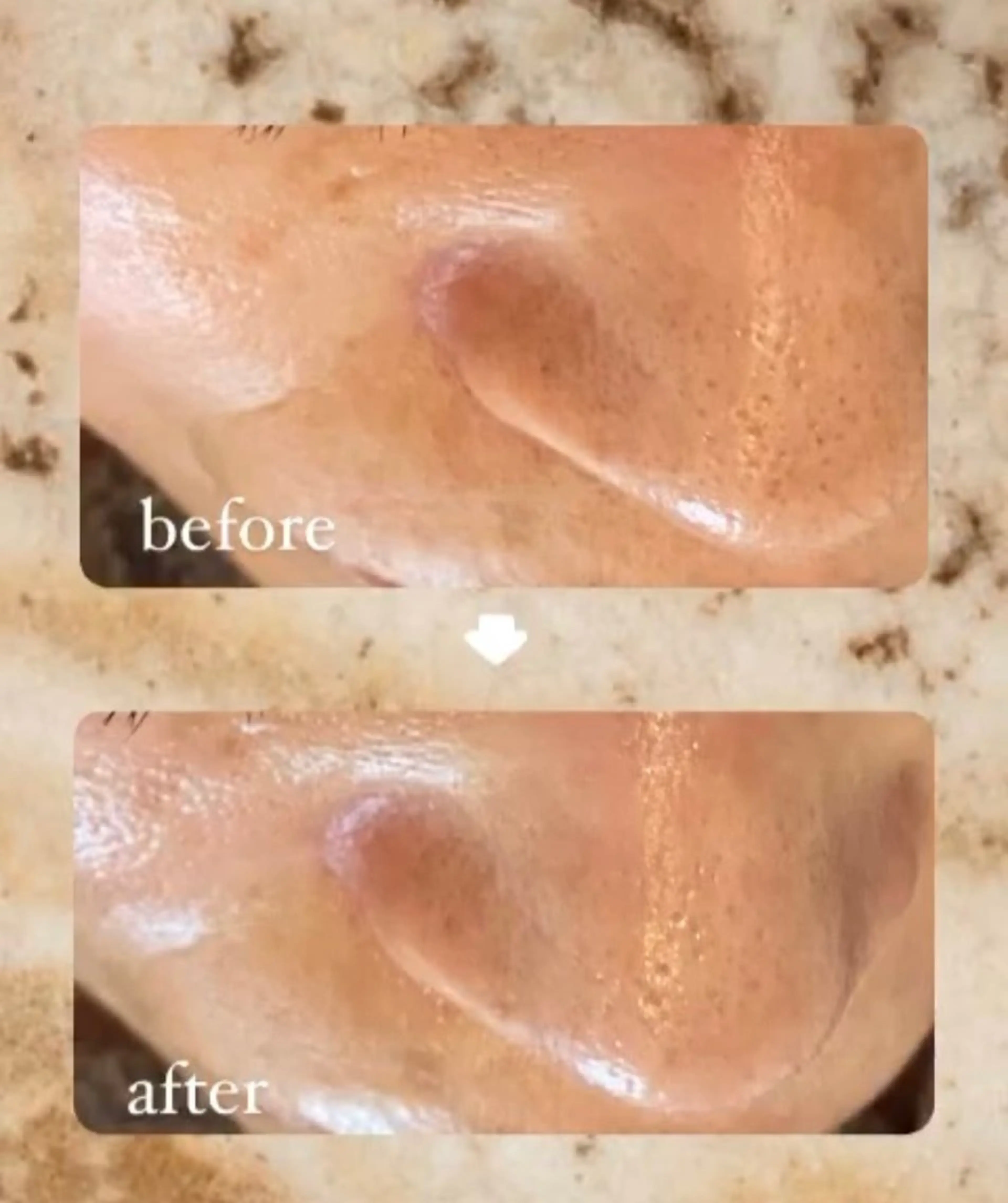 毛穴洗浄ハイドラフェイシャルor光フェイシャルの写真