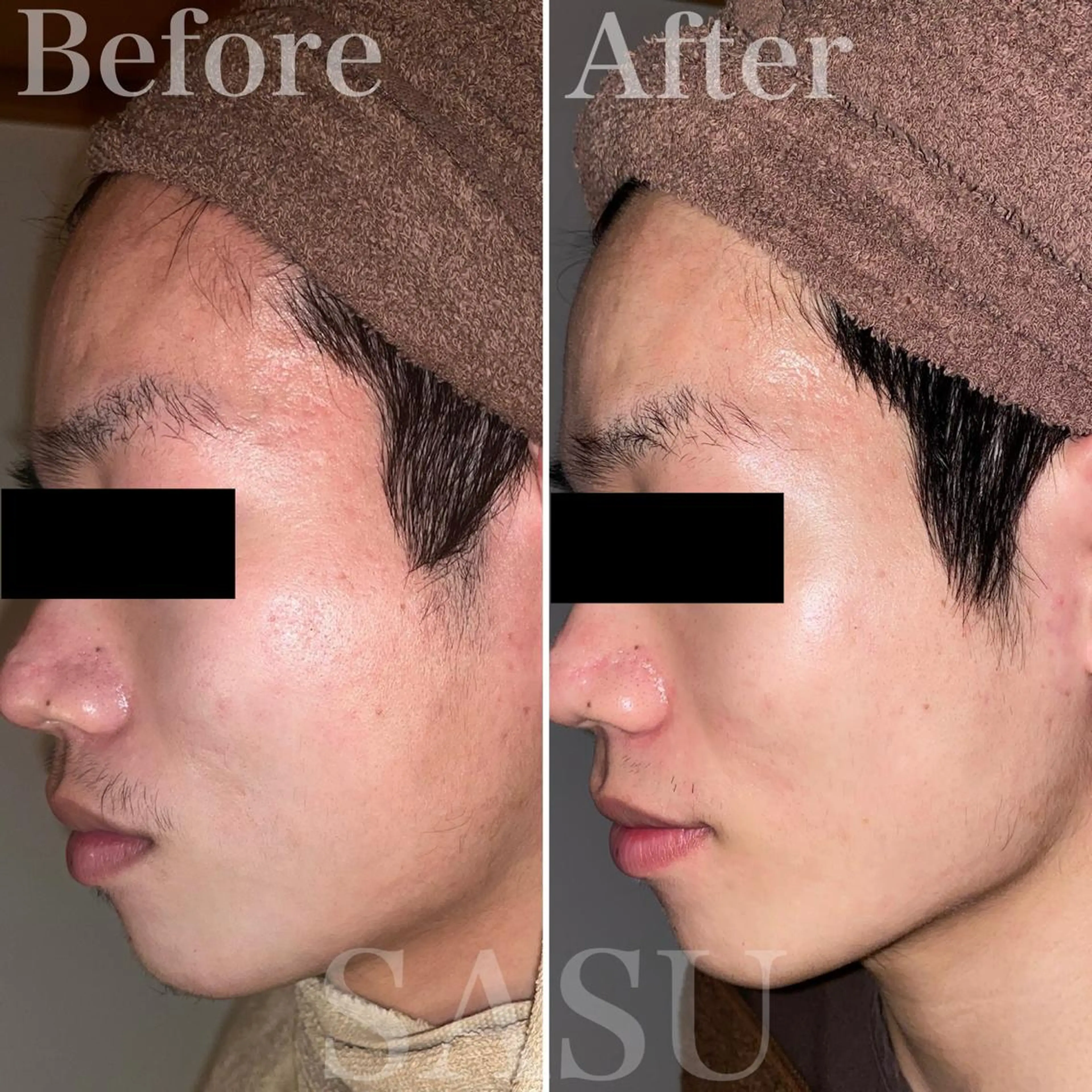 メンズ キッズ 即小顔♥️美容鍼× ハーブピーリングのその他イメージ